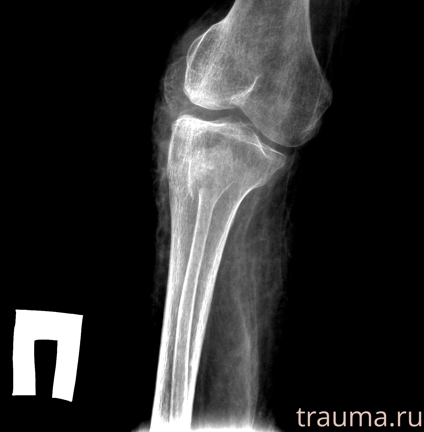 Рентген на дому: по вашему адресу приезжает врач-рентгенолог, травматолог-ортопед с мобильным рентгеновским аппаратом, проводит диагностику травмы или заболевания, делает необходимые рентгенограммы, дает рекомендации по дальнейшему лечению. Получить качественные снимки в домашних условиях возможно благодаря уникальной методике, разработанной МосРентген Центром для института  Склифосовского