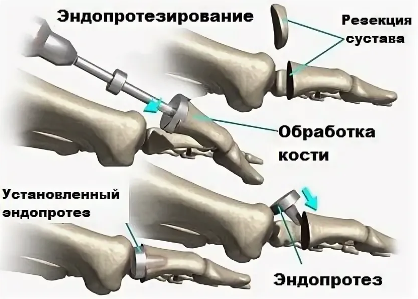 Суставы адрес. Эндопротез 1 плюснефалангового сустава. Эндопротезирование пястно-фаланговых суставов. Эндопротез пястно-фалангового сустава. Артродезирование сустава пальца стопы.