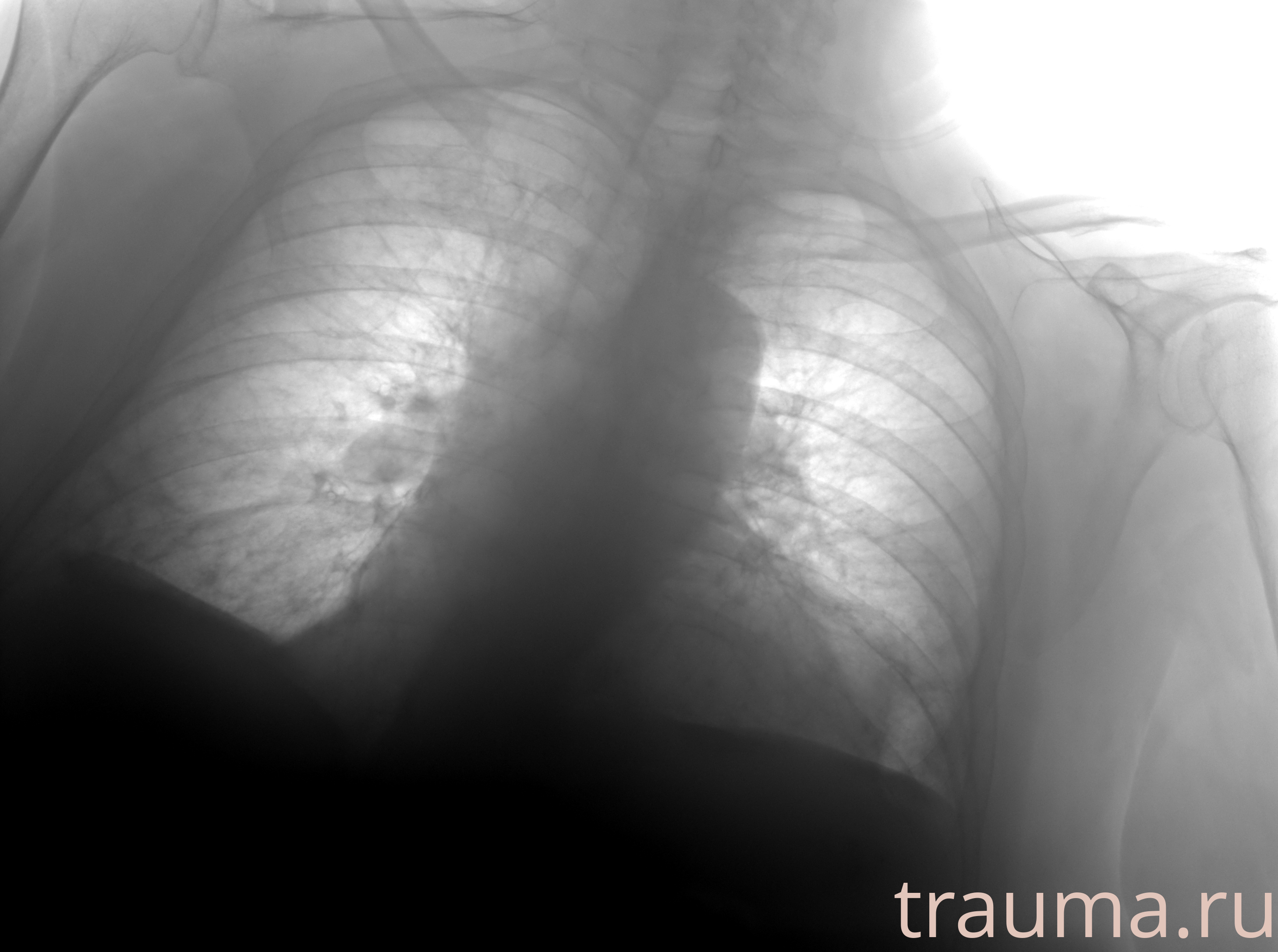 Рентген на дому: по вашему адресу приезжает врач-рентгенолог, травматолог-ортопед с мобильным рентгеновским аппаратом, проводит диагностику травмы или заболевания, делает необходимые рентгенограммы, дает рекомендации по дальнейшему лечению. Получить качественные снимки в домашних условиях возможно благодаря уникальной методике, разработанной МосРентген Центром для института  Склифосовского