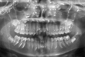 Рентген зубов - особенности и показания
