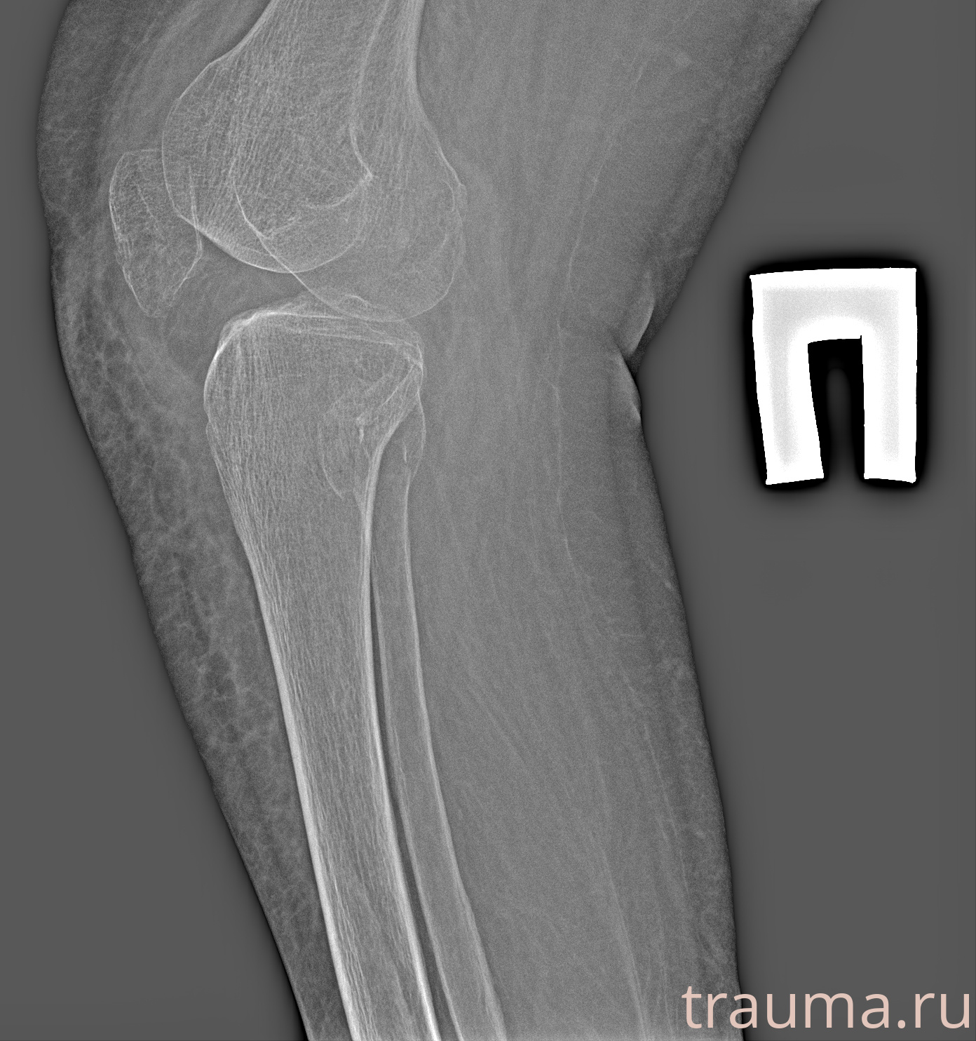 Рентген на дому: по вашему адресу приезжает врач-рентгенолог, травматолог-ортопед с мобильным рентгеновским аппаратом, проводит диагностику травмы или заболевания, делает необходимые рентгенограммы, дает рекомендации по дальнейшему лечению. Получить качественные снимки в домашних условиях возможно благодаря уникальной методике, разработанной МосРентген Центром для института  Склифосовского
