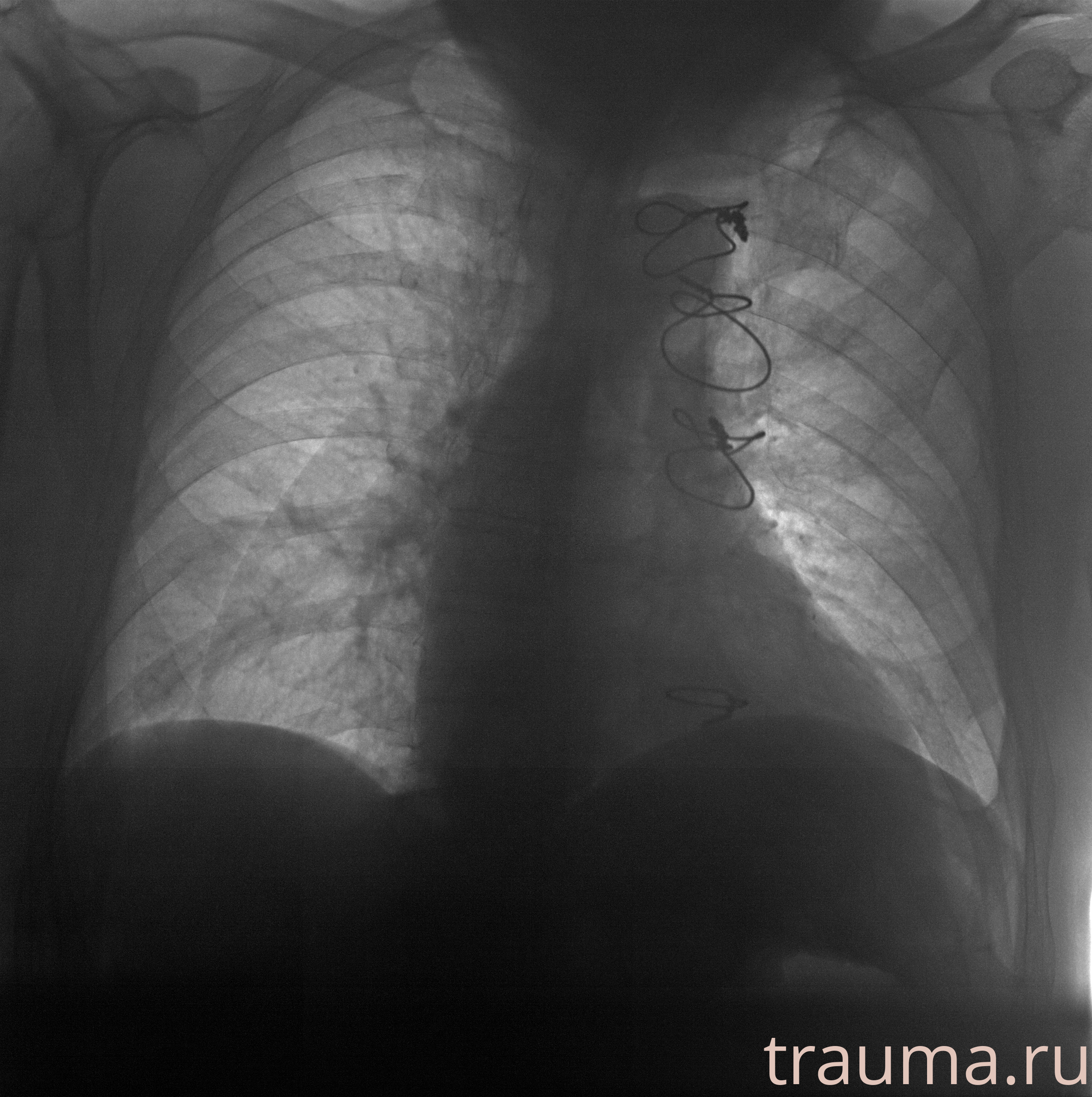 Рентген на дому: по вашему адресу приезжает врач-рентгенолог, травматолог-ортопед с мобильным рентгеновским аппаратом, проводит диагностику травмы или заболевания, делает необходимые рентгенограммы, дает рекомендации по дальнейшему лечению. Получить качественные снимки в домашних условиях возможно благодаря уникальной методике, разработанной МосРентген Центром для института  Склифосовского