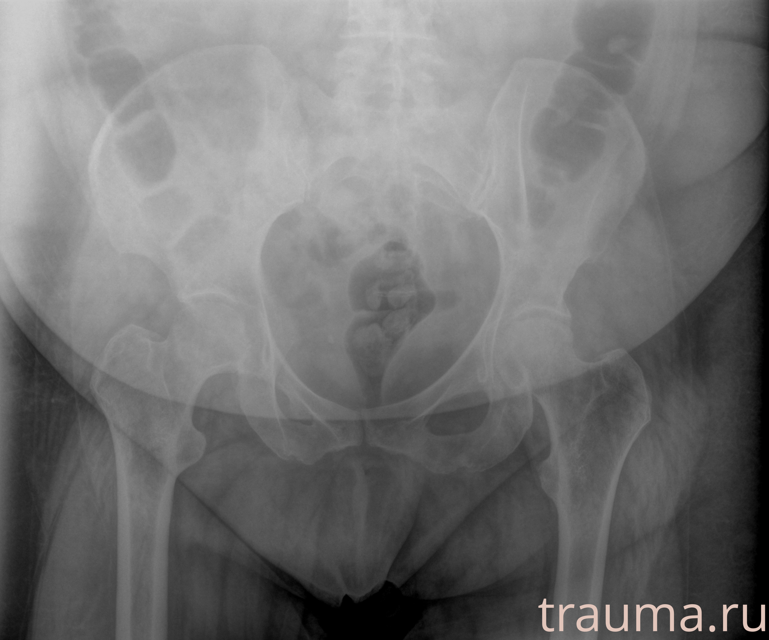 Рентген на дому: по вашему адресу приезжает врач-рентгенолог, травматолог-ортопед с мобильным рентгеновским аппаратом, проводит диагностику травмы или заболевания, делает необходимые рентгенограммы, дает рекомендации по дальнейшему лечению. Получить качественные снимки в домашних условиях возможно благодаря уникальной методике, разработанной МосРентген Центром для института  Склифосовского