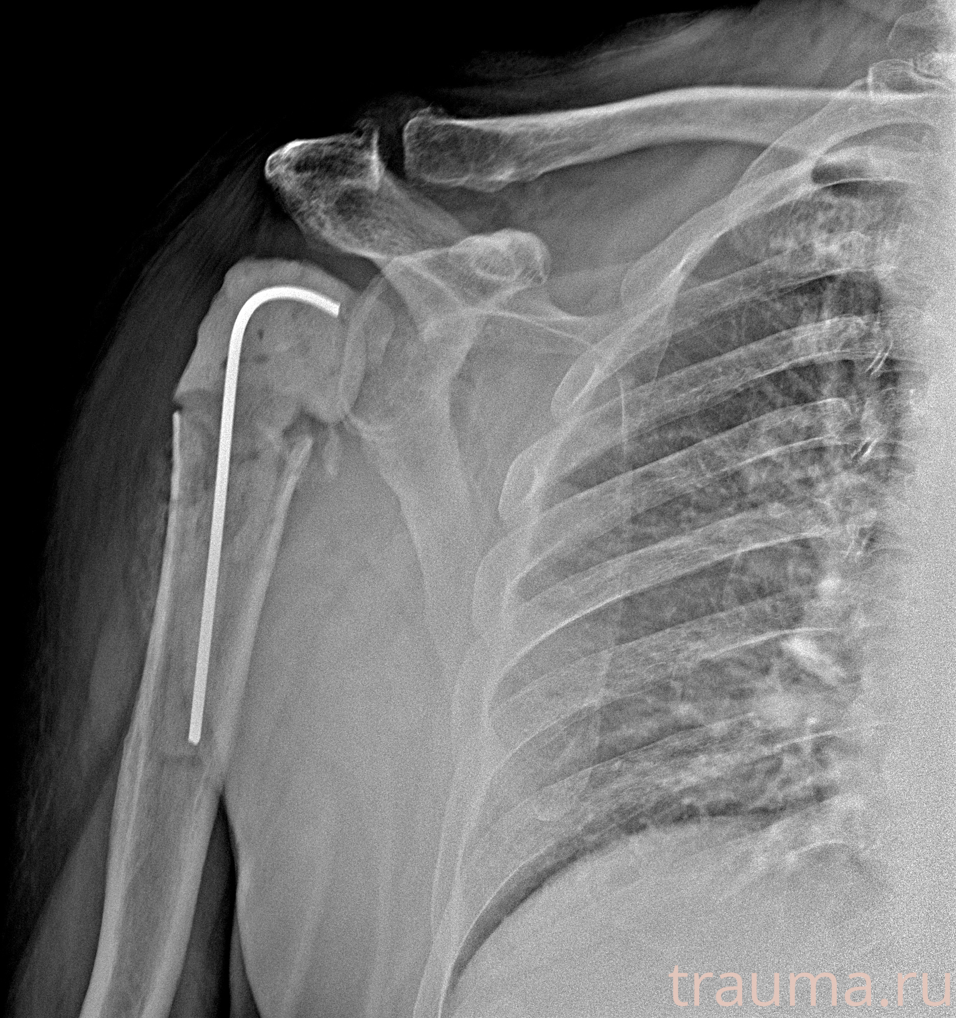 Рентген на дому: по вашему адресу приезжает врач-рентгенолог, травматолог-ортопед с мобильным рентгеновским аппаратом, проводит диагностику травмы или заболевания, делает необходимые рентгенограммы, дает рекомендации по дальнейшему лечению. Получить качественные снимки в домашних условиях возможно благодаря уникальной методике, разработанной МосРентген Центром для института  Склифосовского