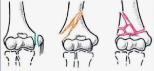 Переломы дистального отдела плечевой кости