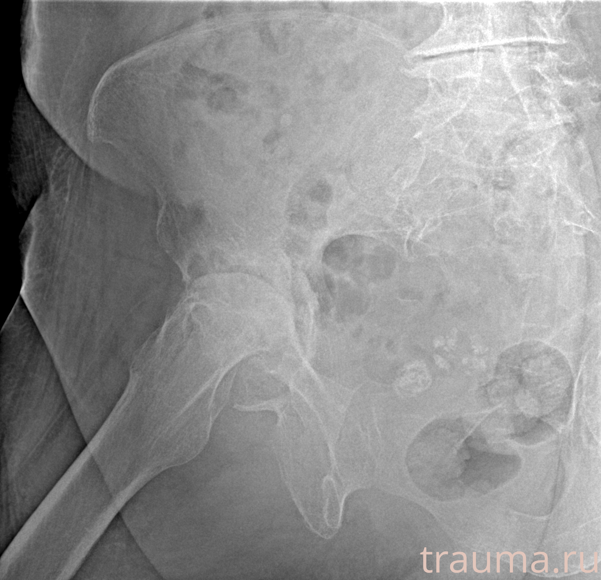 Рентген на дому: по вашему адресу приезжает врач-рентгенолог, травматолог-ортопед с мобильным рентгеновским аппаратом, проводит диагностику травмы или заболевания, делает необходимые рентгенограммы, дает рекомендации по дальнейшему лечению. Получить качественные снимки в домашних условиях возможно благодаря уникальной методике, разработанной МосРентген Центром для института  Склифосовского