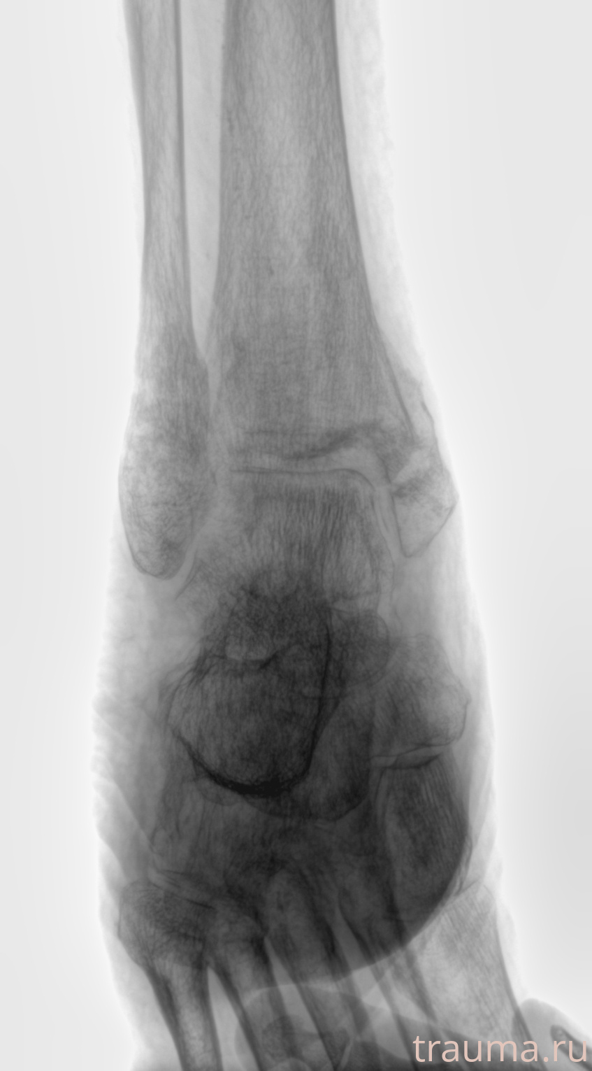 Рентген на дому: по вашему адресу приезжает врач-рентгенолог, травматолог-ортопед с мобильным рентгеновским аппаратом, проводит диагностику травмы или заболевания, делает необходимые рентгенограммы, дает рекомендации по дальнейшему лечению. Получить качественные снимки в домашних условиях возможно благодаря уникальной методике, разработанной МосРентген Центром для института  Склифосовского