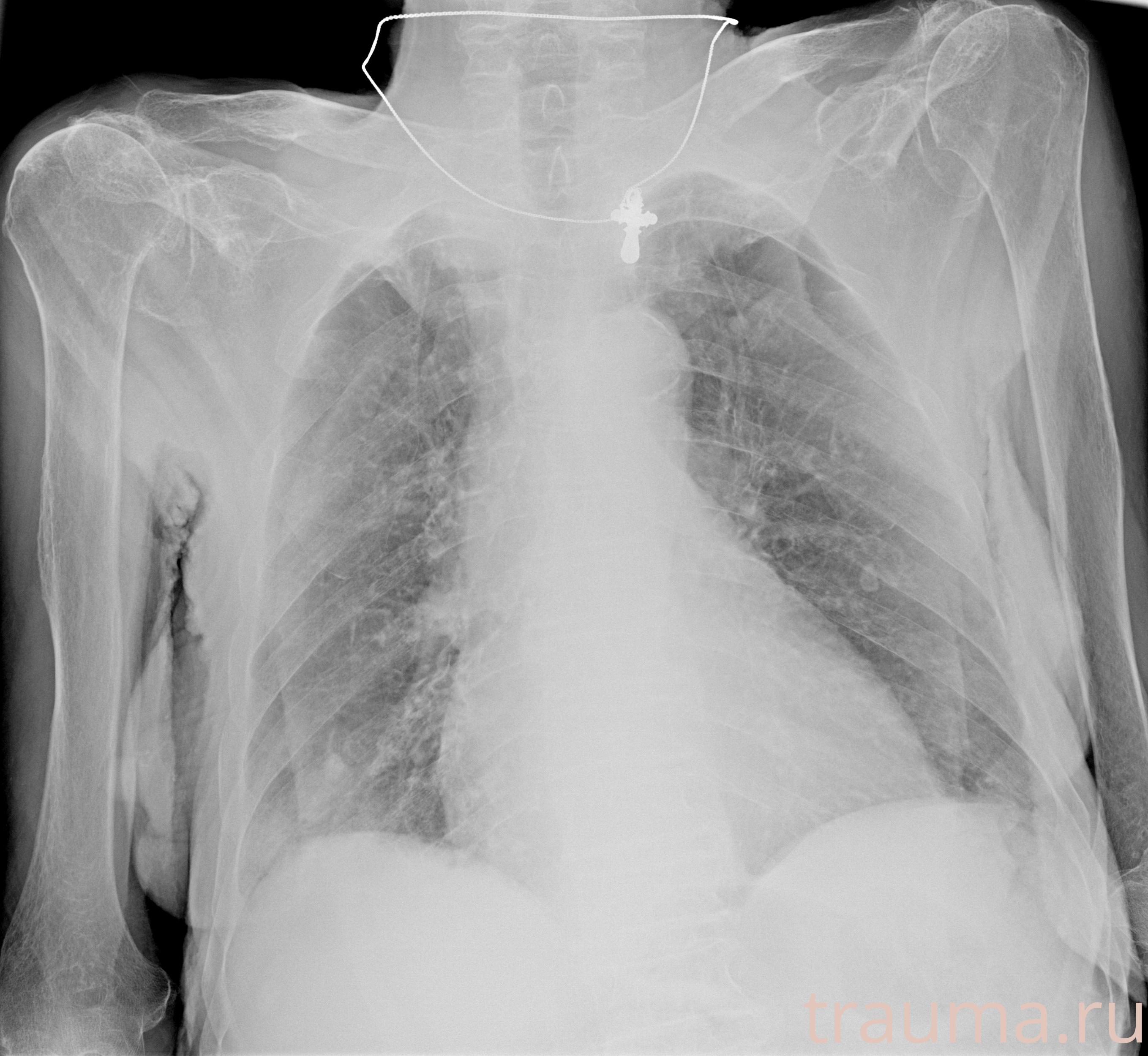 Рентген на дому: по вашему адресу приезжает врач-рентгенолог, травматолог-ортопед с мобильным рентгеновским аппаратом, проводит диагностику травмы или заболевания, делает необходимые рентгенограммы, дает рекомендации по дальнейшему лечению. Получить качественные снимки в домашних условиях возможно благодаря уникальной методике, разработанной МосРентген Центром для института  Склифосовского