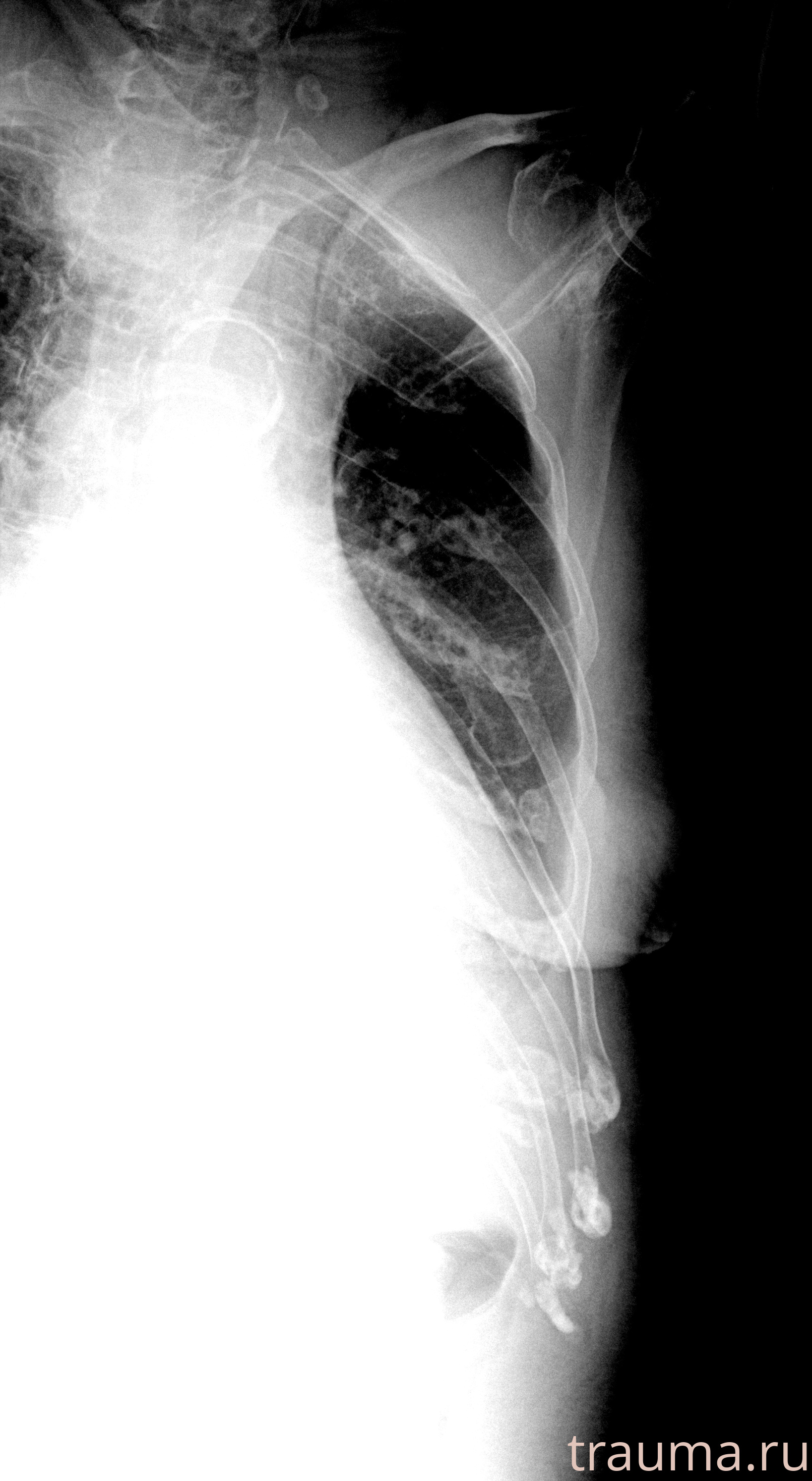 Рентген на дому: по вашему адресу приезжает врач-рентгенолог, травматолог-ортопед с мобильным рентгеновским аппаратом, проводит диагностику травмы или заболевания, делает необходимые рентгенограммы, дает рекомендации по дальнейшему лечению. Получить качественные снимки в домашних условиях возможно благодаря уникальной методике, разработанной МосРентген Центром для института  Склифосовского