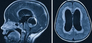 Магнитно-резонансная морфометрия головного мозга у детей с детальной оценкой височных долей