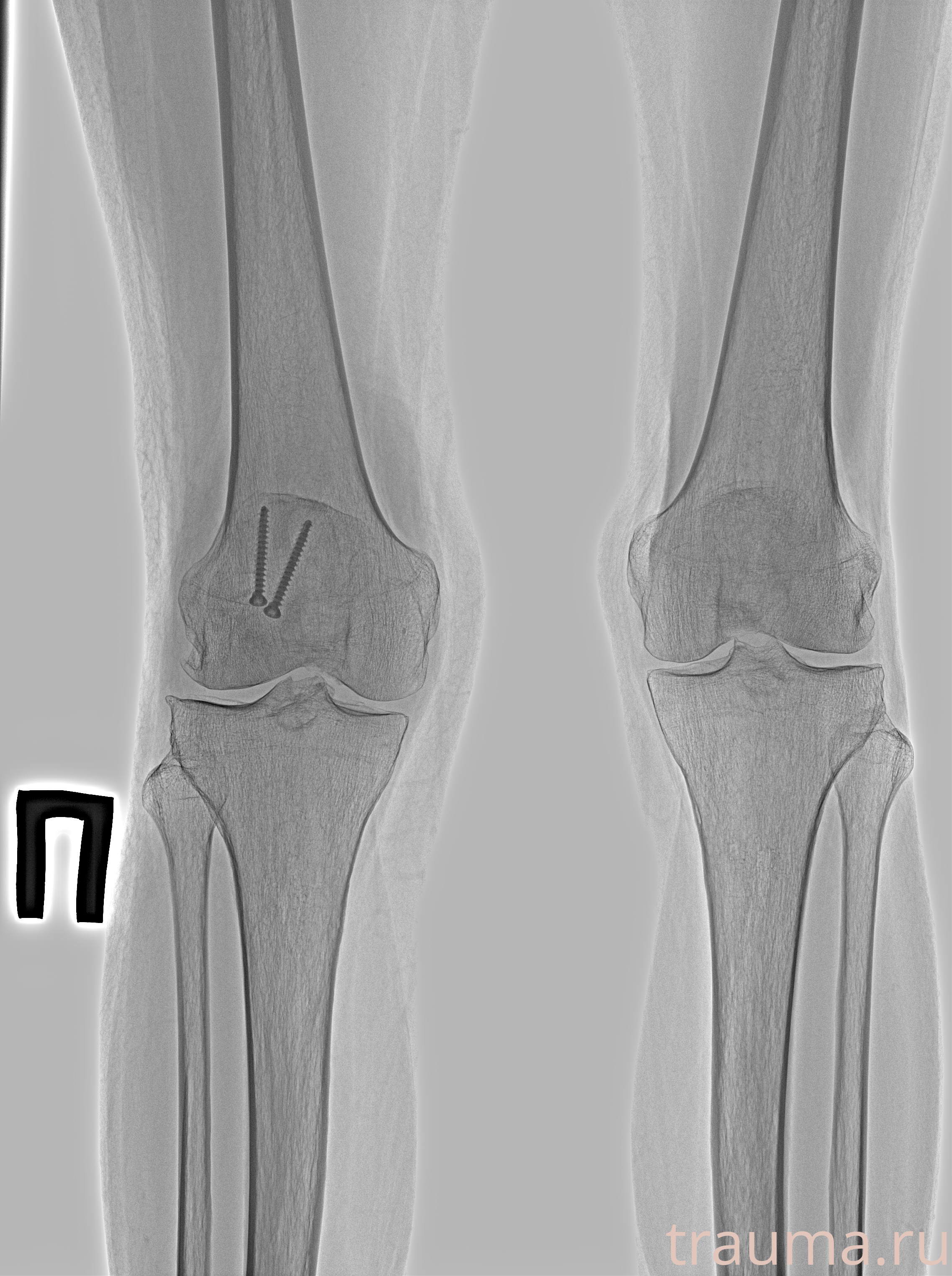Рентген на дому: по вашему адресу приезжает врач-рентгенолог, травматолог-ортопед с мобильным рентгеновским аппаратом, проводит диагностику травмы или заболевания, делает необходимые рентгенограммы, дает рекомендации по дальнейшему лечению. Получить качественные снимки в домашних условиях возможно благодаря уникальной методике, разработанной МосРентген Центром для института  Склифосовского