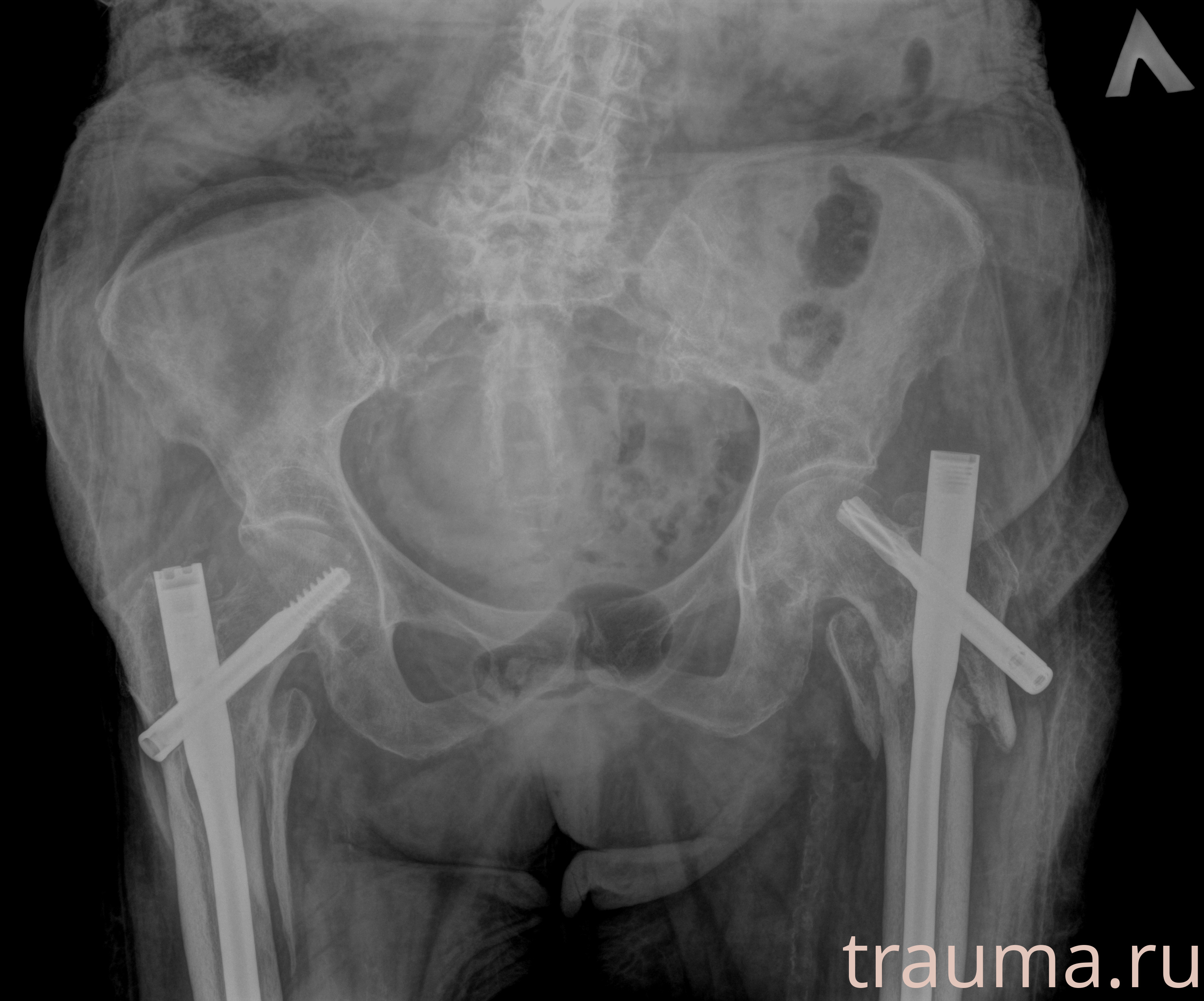 Рентген на дому: по вашему адресу приезжает врач-рентгенолог, травматолог-ортопед с мобильным рентгеновским аппаратом, проводит диагностику травмы или заболевания, делает необходимые рентгенограммы, дает рекомендации по дальнейшему лечению. Получить качественные снимки в домашних условиях возможно благодаря уникальной методике, разработанной МосРентген Центром для института  Склифосовского