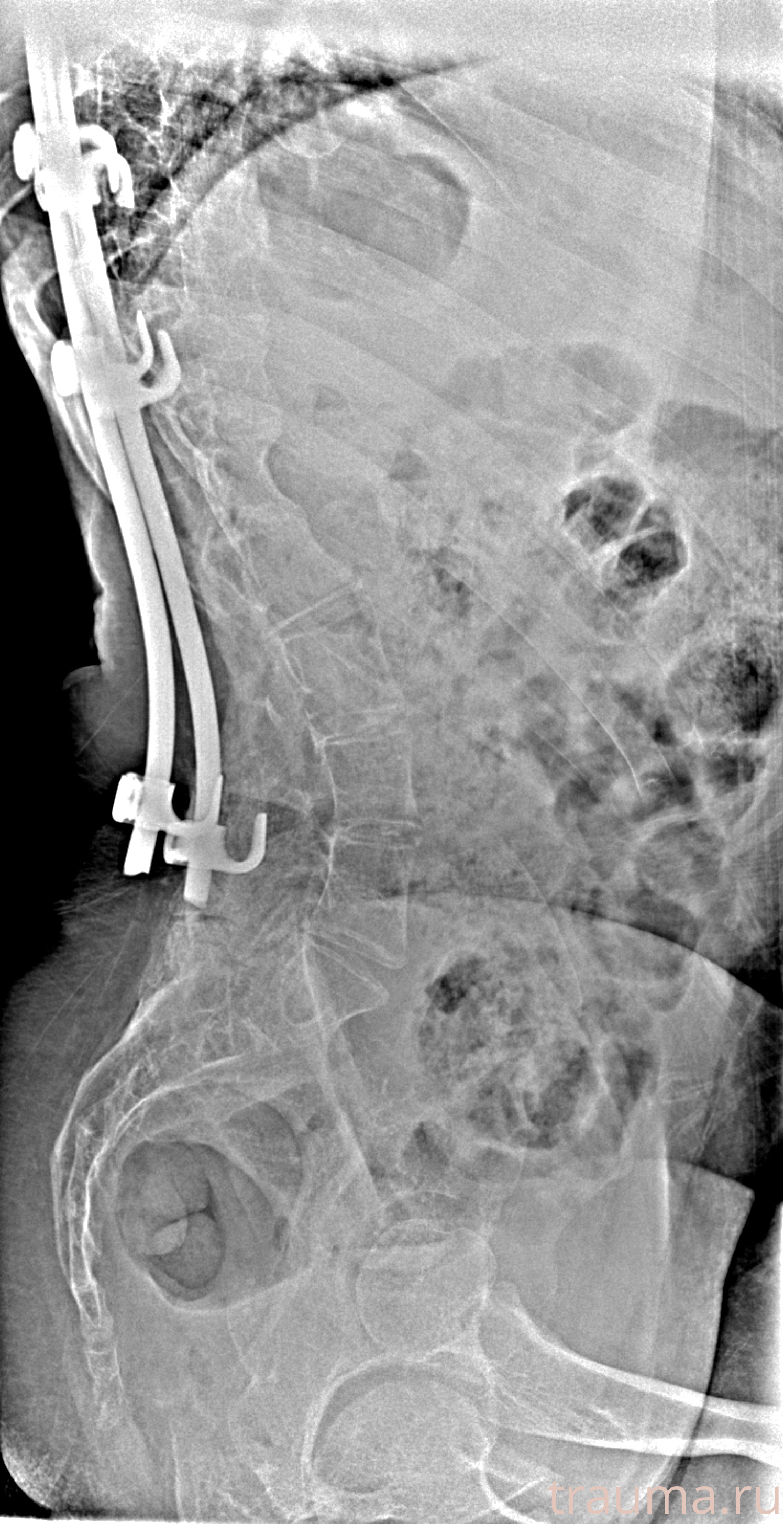 Рентген на дому: по вашему адресу приезжает врач-рентгенолог, травматолог-ортопед с мобильным рентгеновским аппаратом, проводит диагностику травмы или заболевания, делает необходимые рентгенограммы, дает рекомендации по дальнейшему лечению. Получить качественные снимки в домашних условиях возможно благодаря уникальной методике, разработанной МосРентген Центром для института  Склифосовского