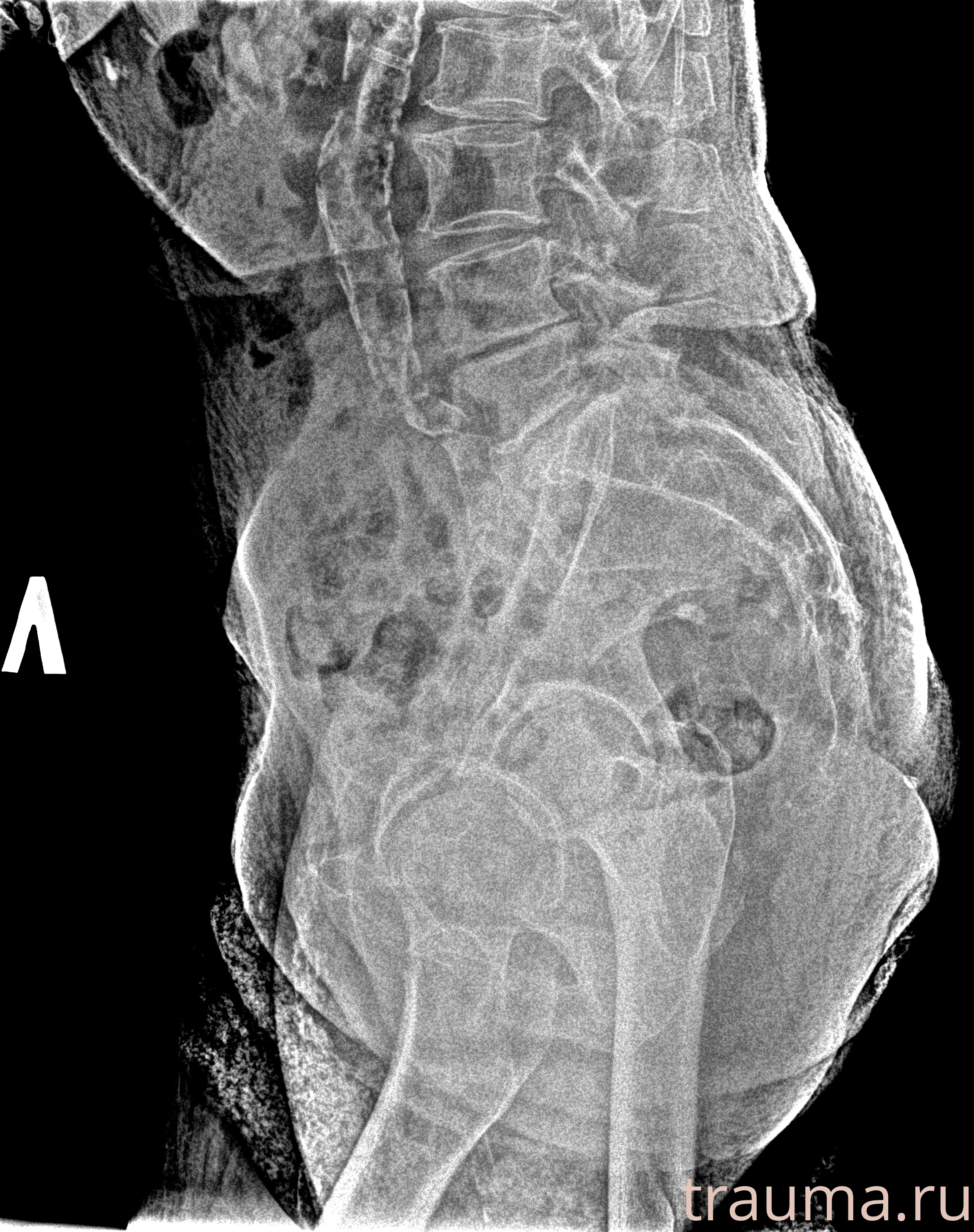 Рентген на дому: по вашему адресу приезжает врач-рентгенолог, травматолог-ортопед с мобильным рентгеновским аппаратом, проводит диагностику травмы или заболевания, делает необходимые рентгенограммы, дает рекомендации по дальнейшему лечению. Получить качественные снимки в домашних условиях возможно благодаря уникальной методике, разработанной МосРентген Центром для института  Склифосовского