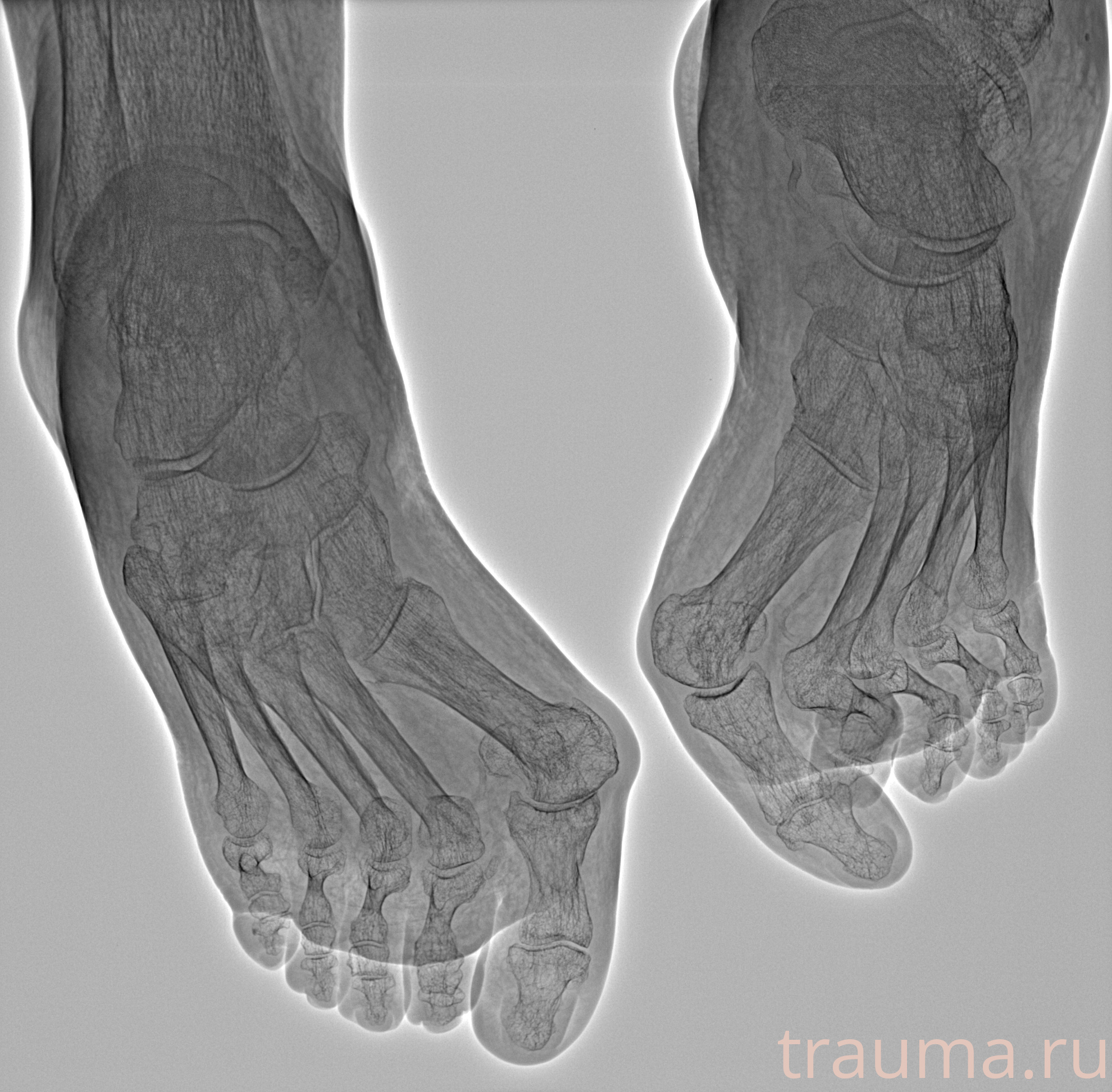 Рентген на дому: по вашему адресу приезжает врач-рентгенолог, травматолог-ортопед с мобильным рентгеновским аппаратом, проводит диагностику травмы или заболевания, делает необходимые рентгенограммы, дает рекомендации по дальнейшему лечению. Получить качественные снимки в домашних условиях возможно благодаря уникальной методике, разработанной МосРентген Центром для института  Склифосовского