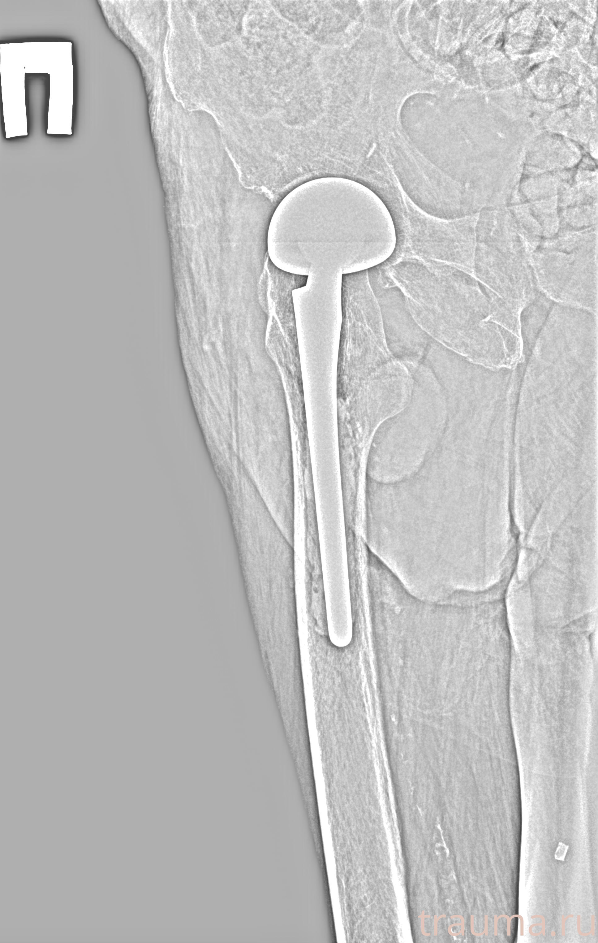 Рентген на дому: по вашему адресу приезжает врач-рентгенолог, травматолог-ортопед с мобильным рентгеновским аппаратом, проводит диагностику травмы или заболевания, делает необходимые рентгенограммы, дает рекомендации по дальнейшему лечению. Получить качественные снимки в домашних условиях возможно благодаря уникальной методике, разработанной МосРентген Центром для института  Склифосовского