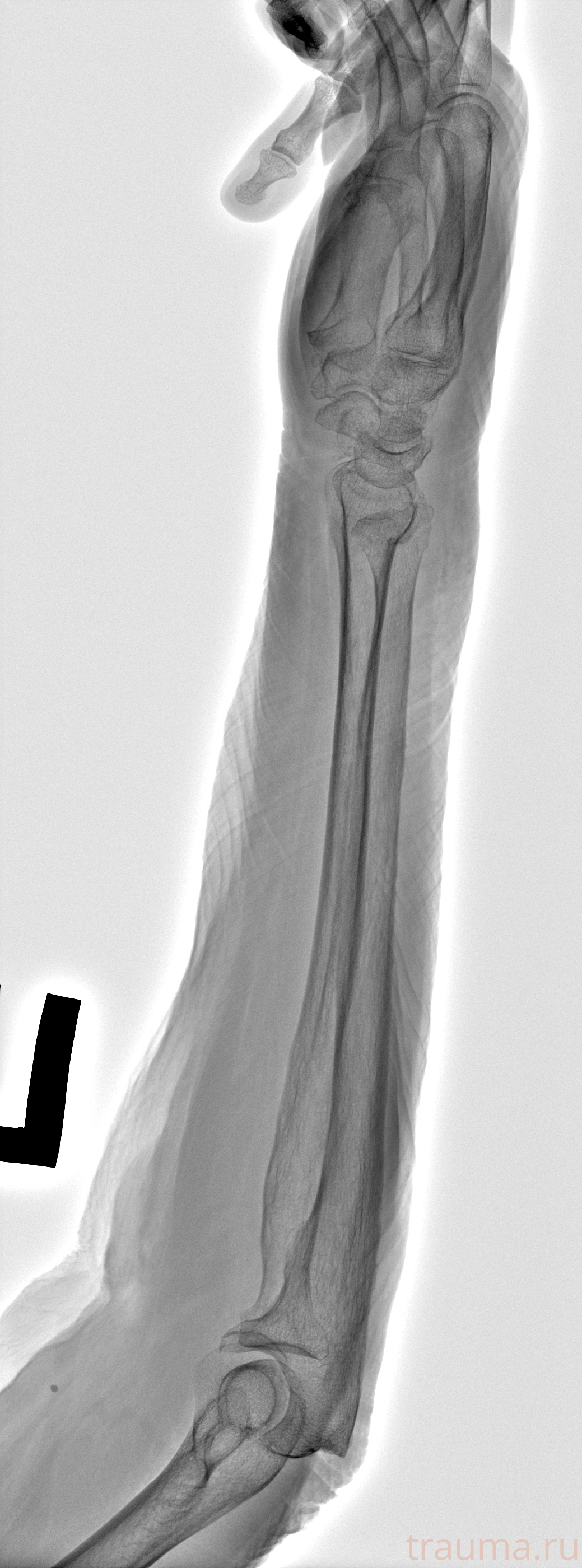 Рентген на дому: по вашему адресу приезжает врач-рентгенолог, травматолог-ортопед с мобильным рентгеновским аппаратом, проводит диагностику травмы или заболевания, делает необходимые рентгенограммы, дает рекомендации по дальнейшему лечению. Получить качественные снимки в домашних условиях возможно благодаря уникальной методике, разработанной МосРентген Центром для института  Склифосовского