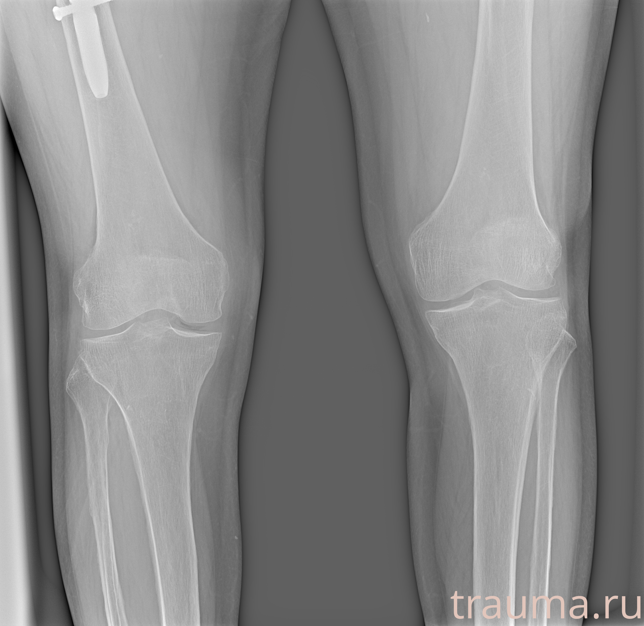 Рентген на дому: по вашему адресу приезжает врач-рентгенолог, травматолог-ортопед с мобильным рентгеновским аппаратом, проводит диагностику травмы или заболевания, делает необходимые рентгенограммы, дает рекомендации по дальнейшему лечению. Получить качественные снимки в домашних условиях возможно благодаря уникальной методике, разработанной МосРентген Центром для института  Склифосовского