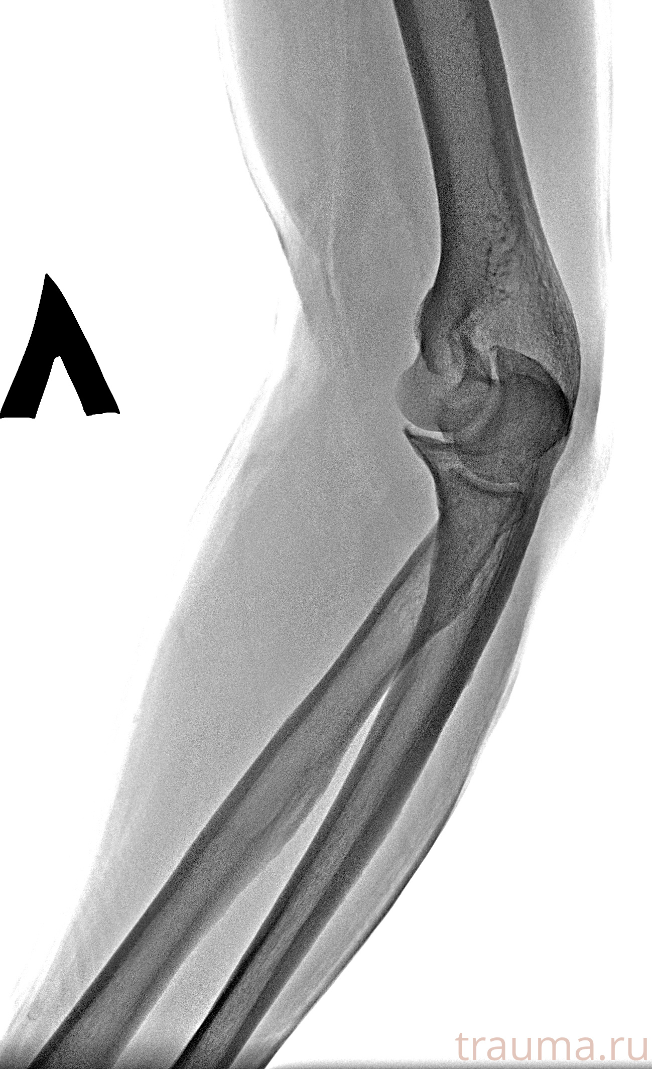 Рентген на дому: по вашему адресу приезжает врач-рентгенолог, травматолог-ортопед с мобильным рентгеновским аппаратом, проводит диагностику травмы или заболевания, делает необходимые рентгенограммы, дает рекомендации по дальнейшему лечению. Получить качественные снимки в домашних условиях возможно благодаря уникальной методике, разработанной МосРентген Центром для института  Склифосовского