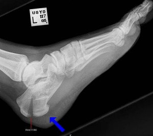Переломы пяточной кости 