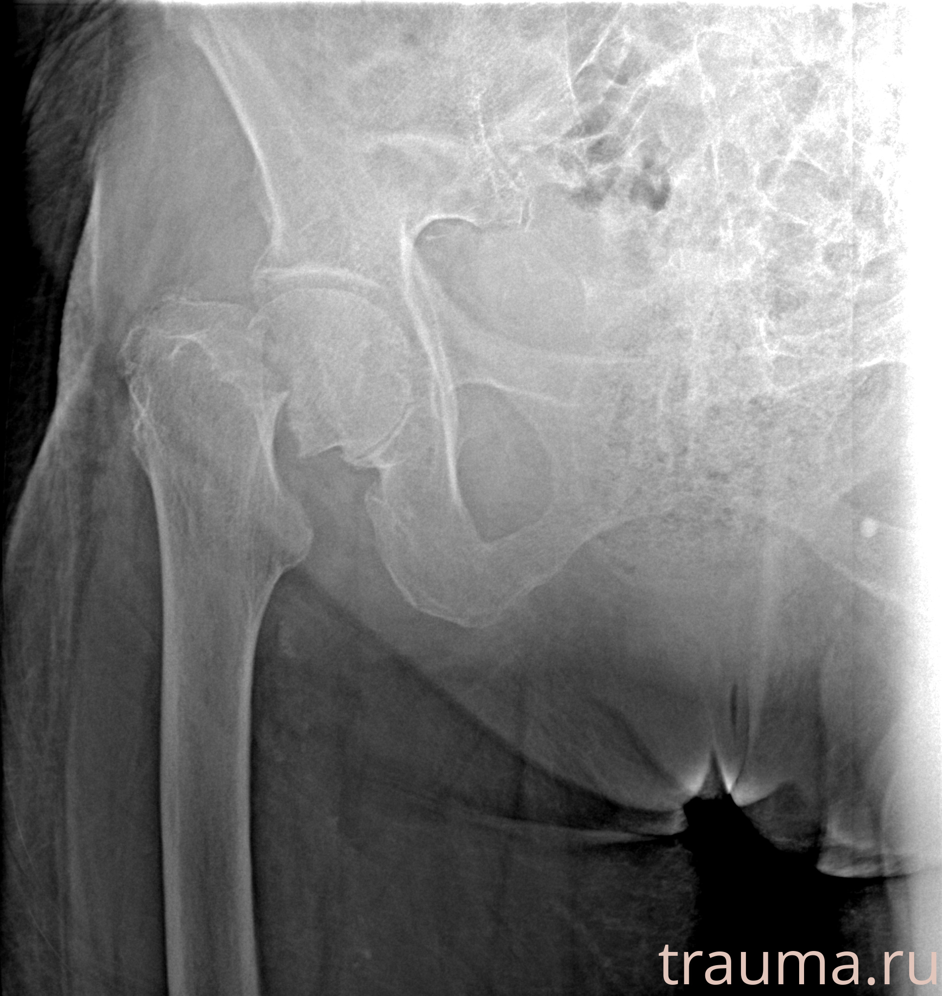 Рентген на дому: по вашему адресу приезжает врач-рентгенолог, травматолог-ортопед с мобильным рентгеновским аппаратом, проводит диагностику травмы или заболевания, делает необходимые рентгенограммы, дает рекомендации по дальнейшему лечению. Получить качественные снимки в домашних условиях возможно благодаря уникальной методике, разработанной МосРентген Центром для института  Склифосовского