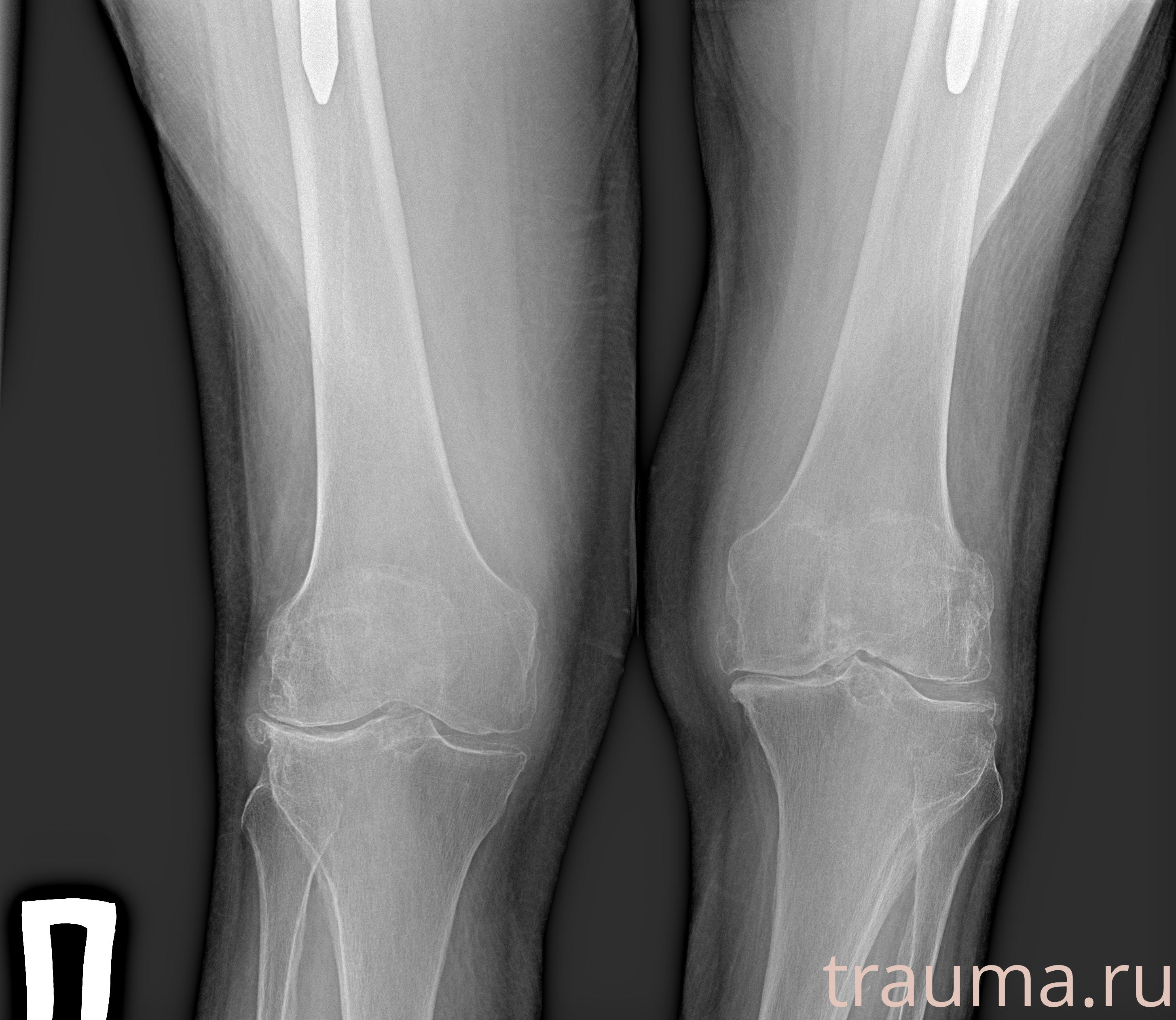 Рентген на дому: по вашему адресу приезжает врач-рентгенолог, травматолог-ортопед с мобильным рентгеновским аппаратом, проводит диагностику травмы или заболевания, делает необходимые рентгенограммы, дает рекомендации по дальнейшему лечению. Получить качественные снимки в домашних условиях возможно благодаря уникальной методике, разработанной МосРентген Центром для института  Склифосовского