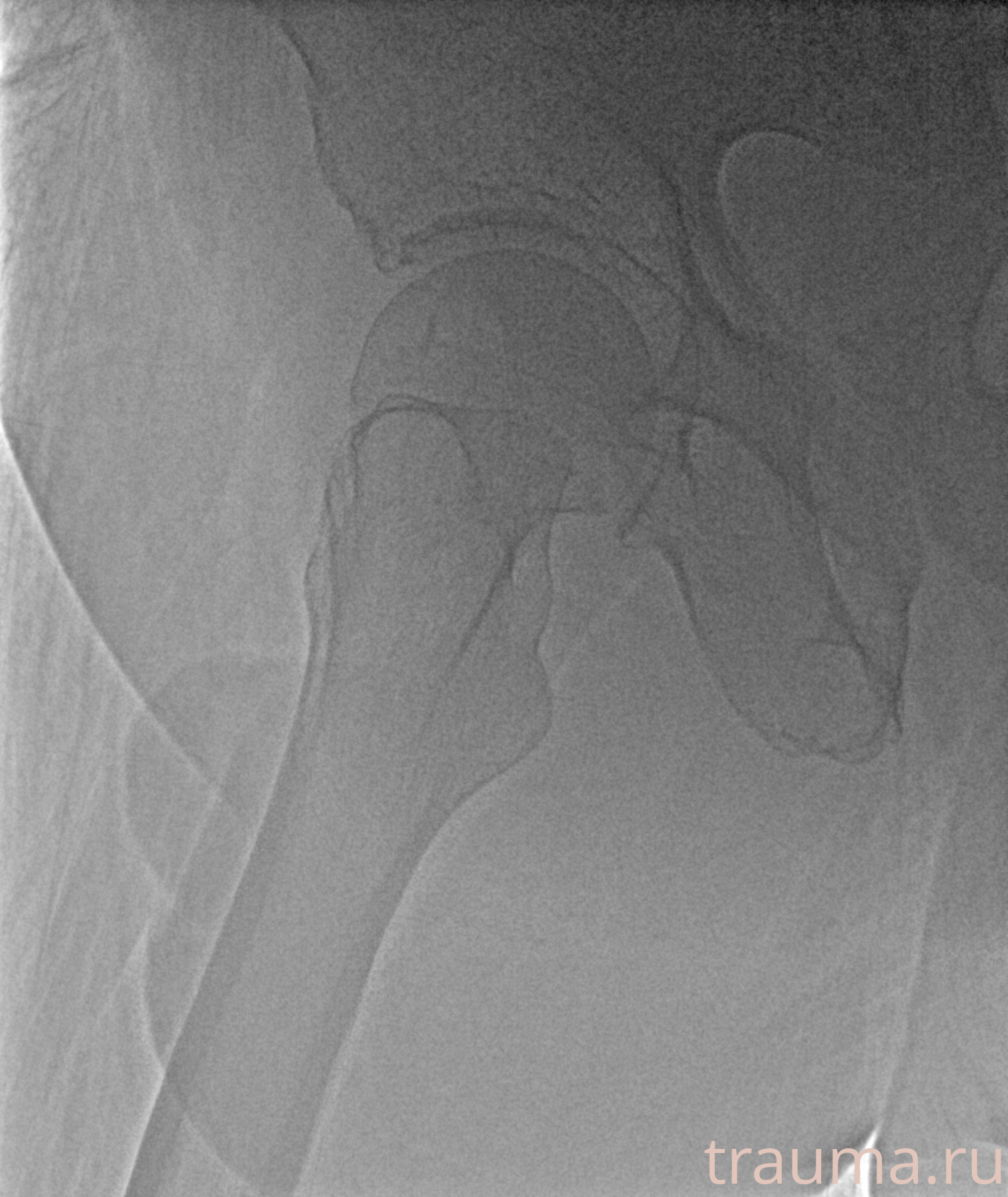 Рентген на дому: по вашему адресу приезжает врач-рентгенолог, травматолог-ортопед с мобильным рентгеновским аппаратом, проводит диагностику травмы или заболевания, делает необходимые рентгенограммы, дает рекомендации по дальнейшему лечению. Получить качественные снимки в домашних условиях возможно благодаря уникальной методике, разработанной МосРентген Центром для института  Склифосовского