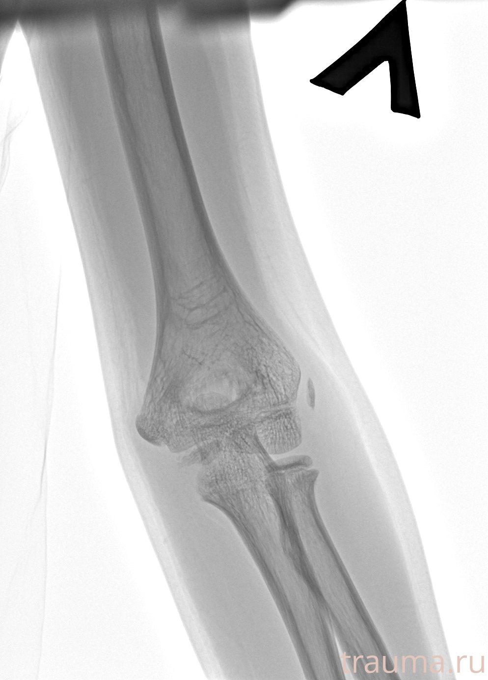 Рентген на дому: по вашему адресу приезжает врач-рентгенолог, травматолог-ортопед с мобильным рентгеновским аппаратом, проводит диагностику травмы или заболевания, делает необходимые рентгенограммы, дает рекомендации по дальнейшему лечению. Получить качественные снимки в домашних условиях возможно благодаря уникальной методике, разработанной МосРентген Центром для института  Склифосовского