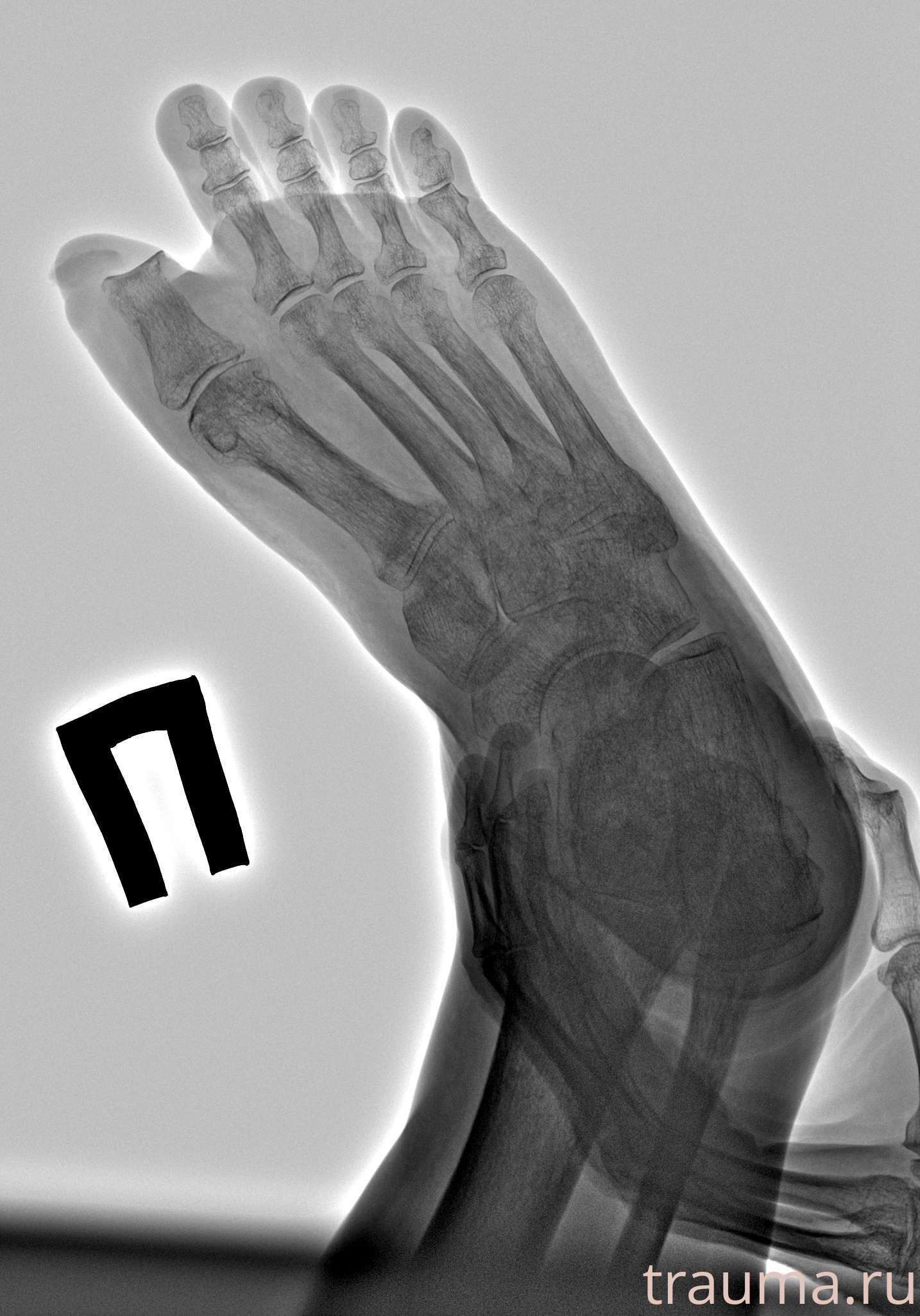 Рентген на дому: по вашему адресу приезжает врач-рентгенолог, травматолог-ортопед с мобильным рентгеновским аппаратом, проводит диагностику травмы или заболевания, делает необходимые рентгенограммы, дает рекомендации по дальнейшему лечению. Получить качественные снимки в домашних условиях возможно благодаря уникальной методике, разработанной МосРентген Центром для института  Склифосовского