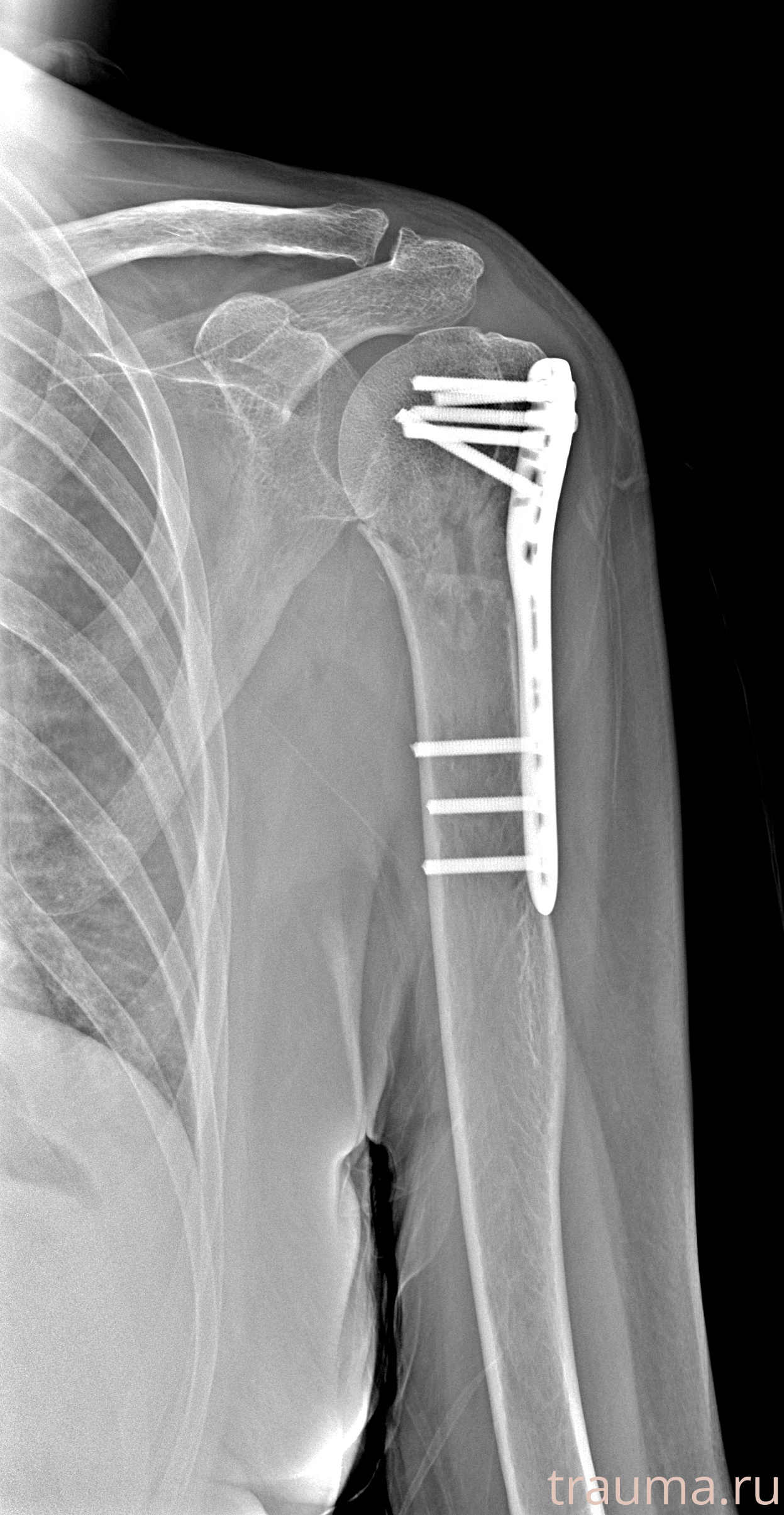 Рентген на дому: по вашему адресу приезжает врач-рентгенолог, травматолог-ортопед с мобильным рентгеновским аппаратом, проводит диагностику травмы или заболевания, делает необходимые рентгенограммы, дает рекомендации по дальнейшему лечению. Получить качественные снимки в домашних условиях возможно благодаря уникальной методике, разработанной МосРентген Центром для института  Склифосовского