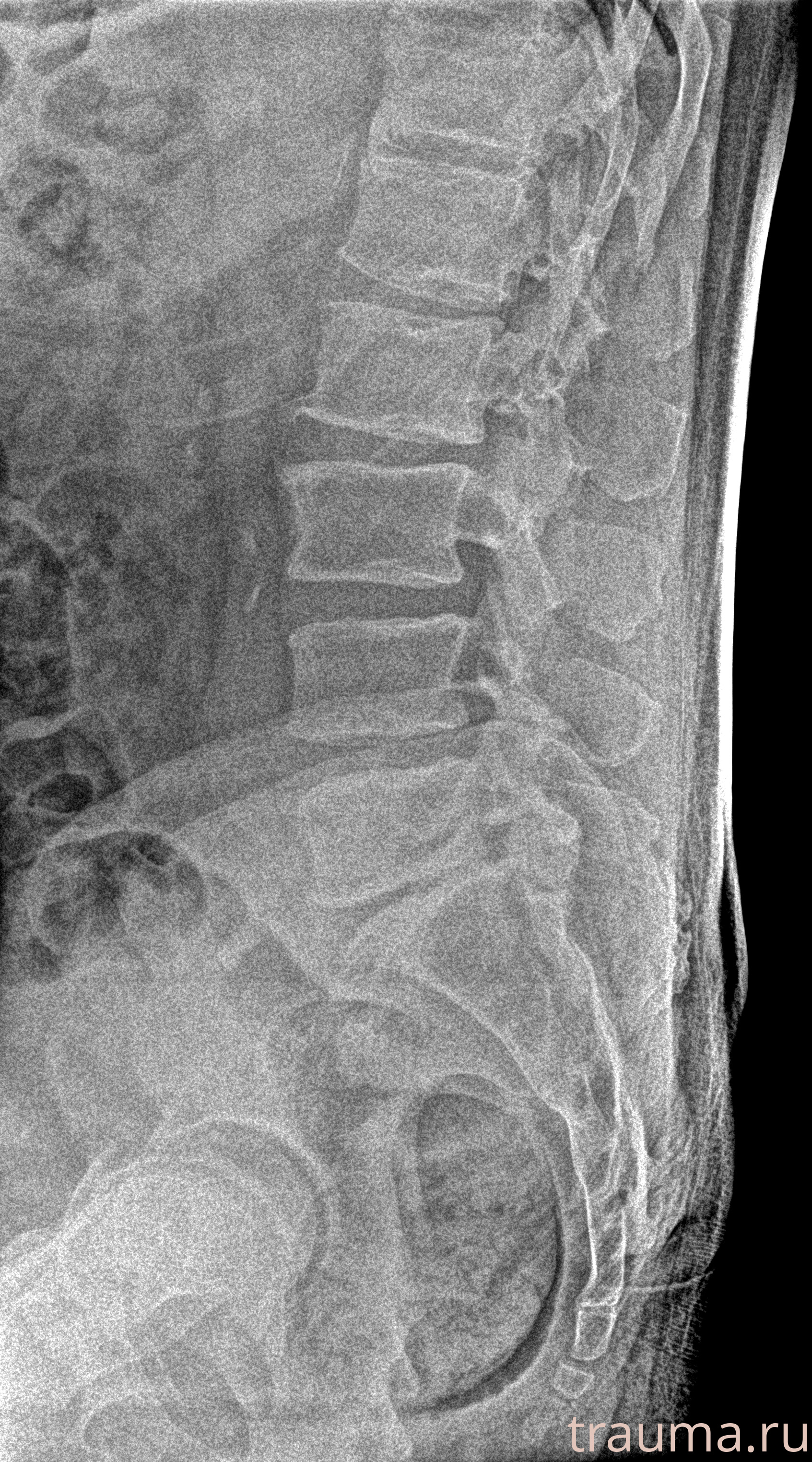 Рентген на дому: по вашему адресу приезжает врач-рентгенолог, травматолог-ортопед с мобильным рентгеновским аппаратом, проводит диагностику травмы или заболевания, делает необходимые рентгенограммы, дает рекомендации по дальнейшему лечению. Получить качественные снимки в домашних условиях возможно благодаря уникальной методике, разработанной МосРентген Центром для института  Склифосовского