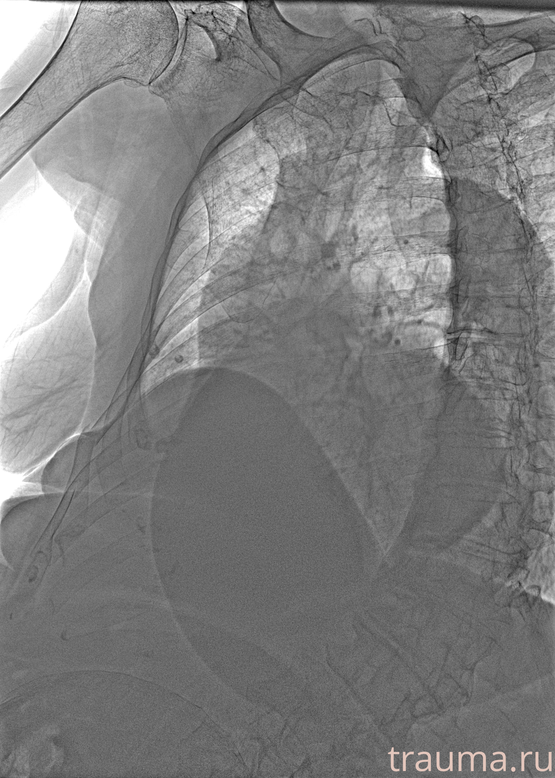 Рентген на дому: по вашему адресу приезжает врач-рентгенолог, травматолог-ортопед с мобильным рентгеновским аппаратом, проводит диагностику травмы или заболевания, делает необходимые рентгенограммы, дает рекомендации по дальнейшему лечению. Получить качественные снимки в домашних условиях возможно благодаря уникальной методике, разработанной МосРентген Центром для института  Склифосовского