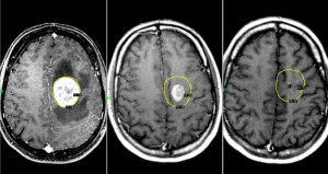 Магнитно-резонансная томография в диагностике и моделировании нейрохирургических вмешательств при метастазах опухолей в головной мозг 