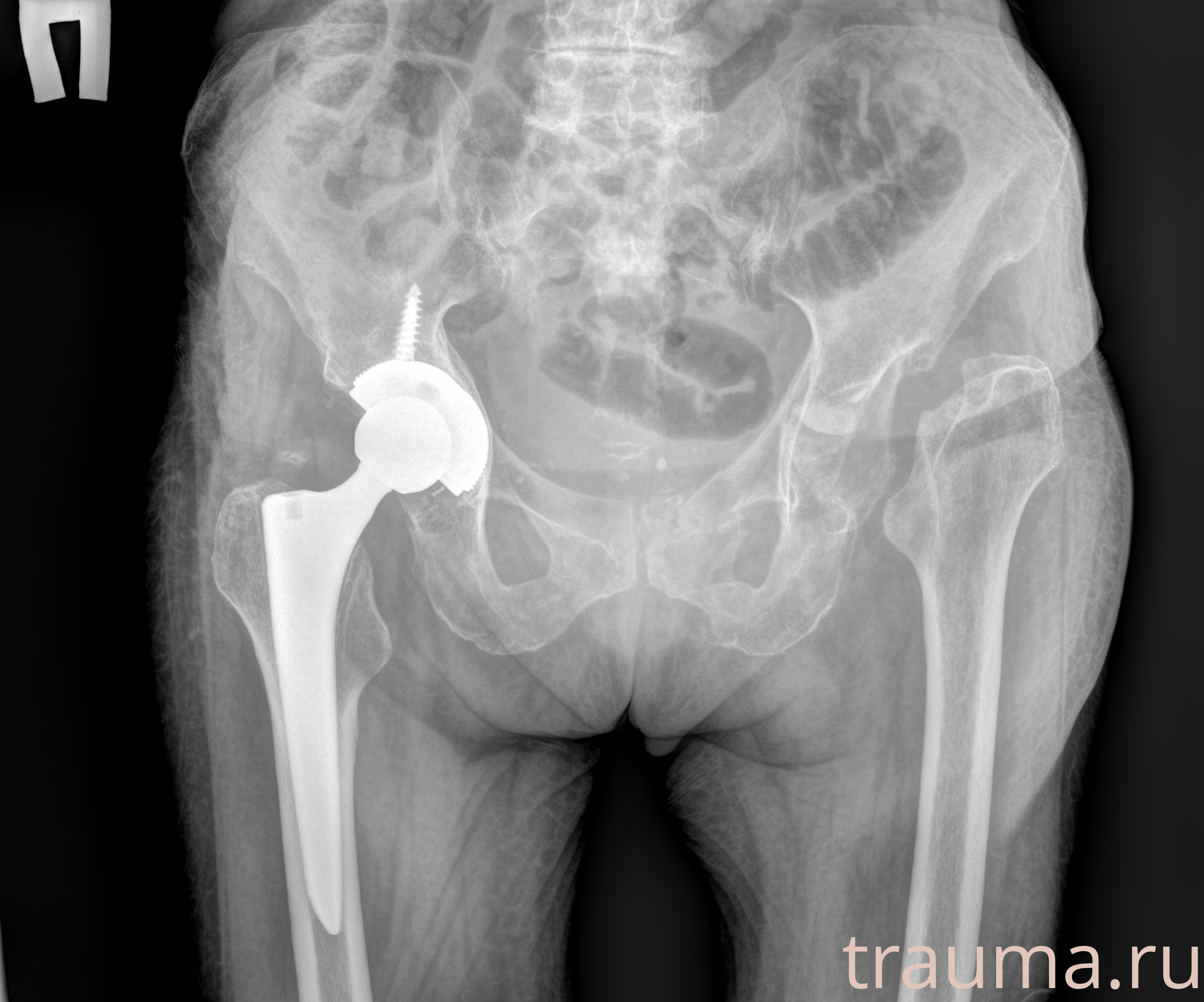 Рентген на дому: по вашему адресу приезжает врач-рентгенолог, травматолог-ортопед с мобильным рентгеновским аппаратом, проводит диагностику травмы или заболевания, делает необходимые рентгенограммы, дает рекомендации по дальнейшему лечению. Получить качественные снимки в домашних условиях возможно благодаря уникальной методике, разработанной МосРентген Центром для института  Склифосовского