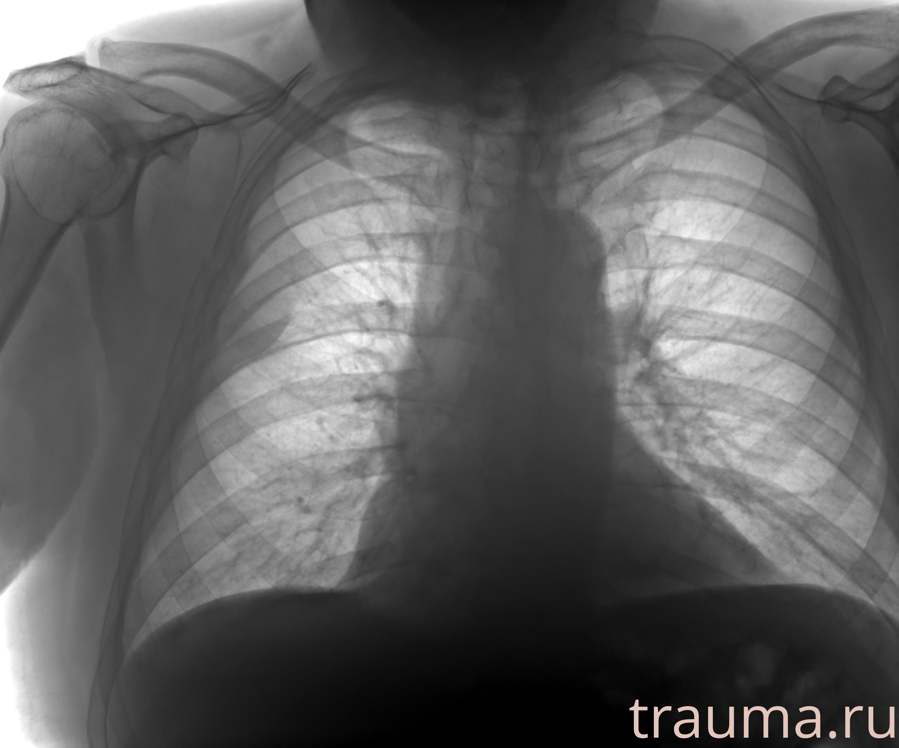 Рентген на дому: по вашему адресу приезжает врач-рентгенолог, травматолог-ортопед с мобильным рентгеновским аппаратом, проводит диагностику травмы или заболевания, делает необходимые рентгенограммы, дает рекомендации по дальнейшему лечению. Получить качественные снимки в домашних условиях возможно благодаря уникальной методике, разработанной МосРентген Центром для института  Склифосовского