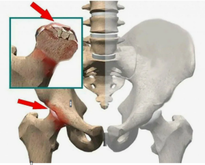 Остеонекроз головки бедренной кости — еще одно наследие COVID-19?