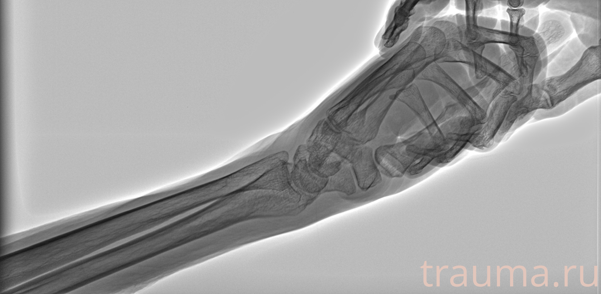 Рентген на дому: по вашему адресу приезжает врач-рентгенолог, травматолог-ортопед с мобильным рентгеновским аппаратом, проводит диагностику травмы или заболевания, делает необходимые рентгенограммы, дает рекомендации по дальнейшему лечению. Получить качественные снимки в домашних условиях возможно благодаря уникальной методике, разработанной МосРентген Центром для института  Склифосовского