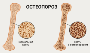 Место ризедроната в лечении постменопаузального остеопароза
Место ризедроната в лечении постменопаузального остеопароза