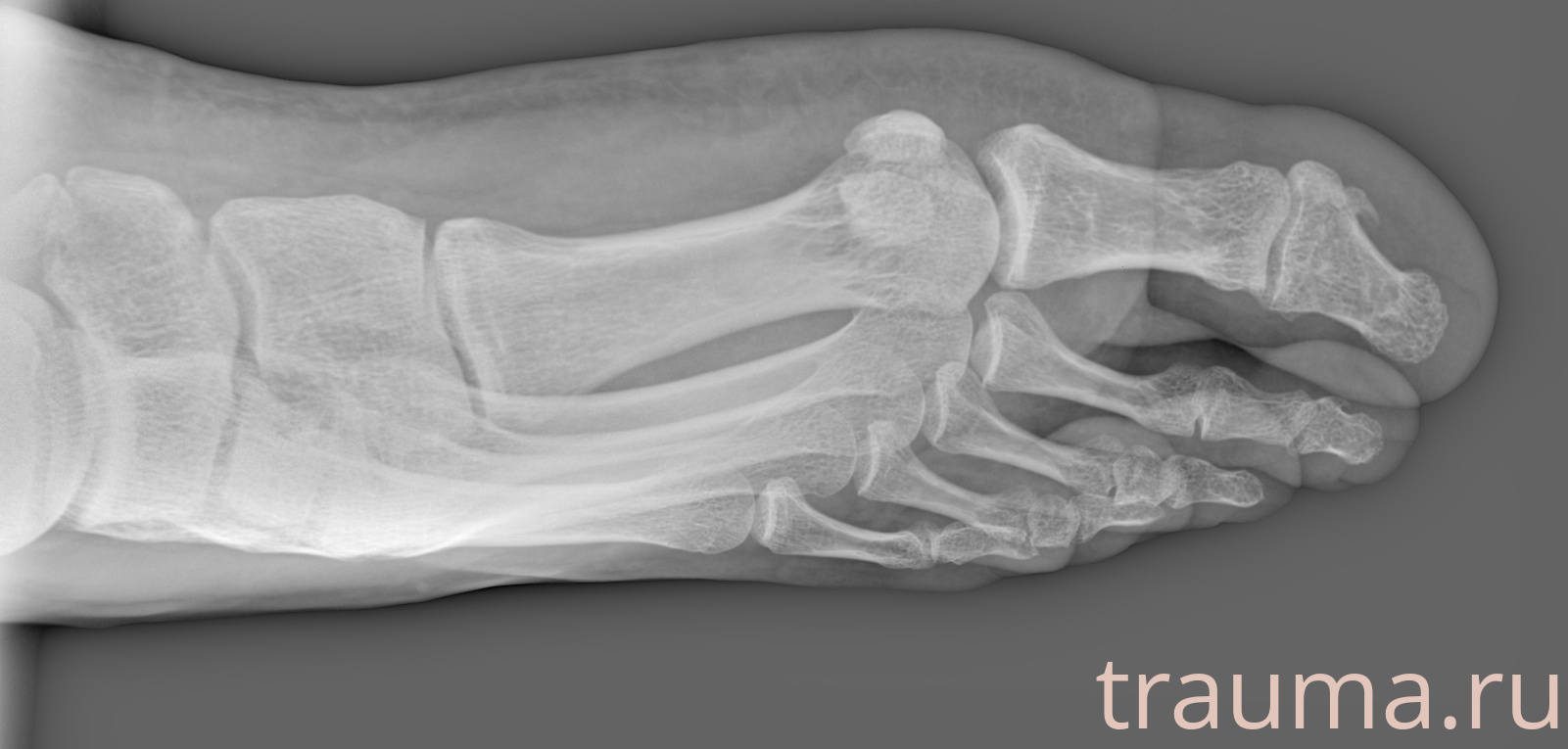 Рентген на дому: по вашему адресу приезжает врач-рентгенолог, травматолог-ортопед с мобильным рентгеновским аппаратом, проводит диагностику травмы или заболевания, делает необходимые рентгенограммы, дает рекомендации по дальнейшему лечению. Получить качественные снимки в домашних условиях возможно благодаря уникальной методике, разработанной МосРентген Центром для института  Склифосовского