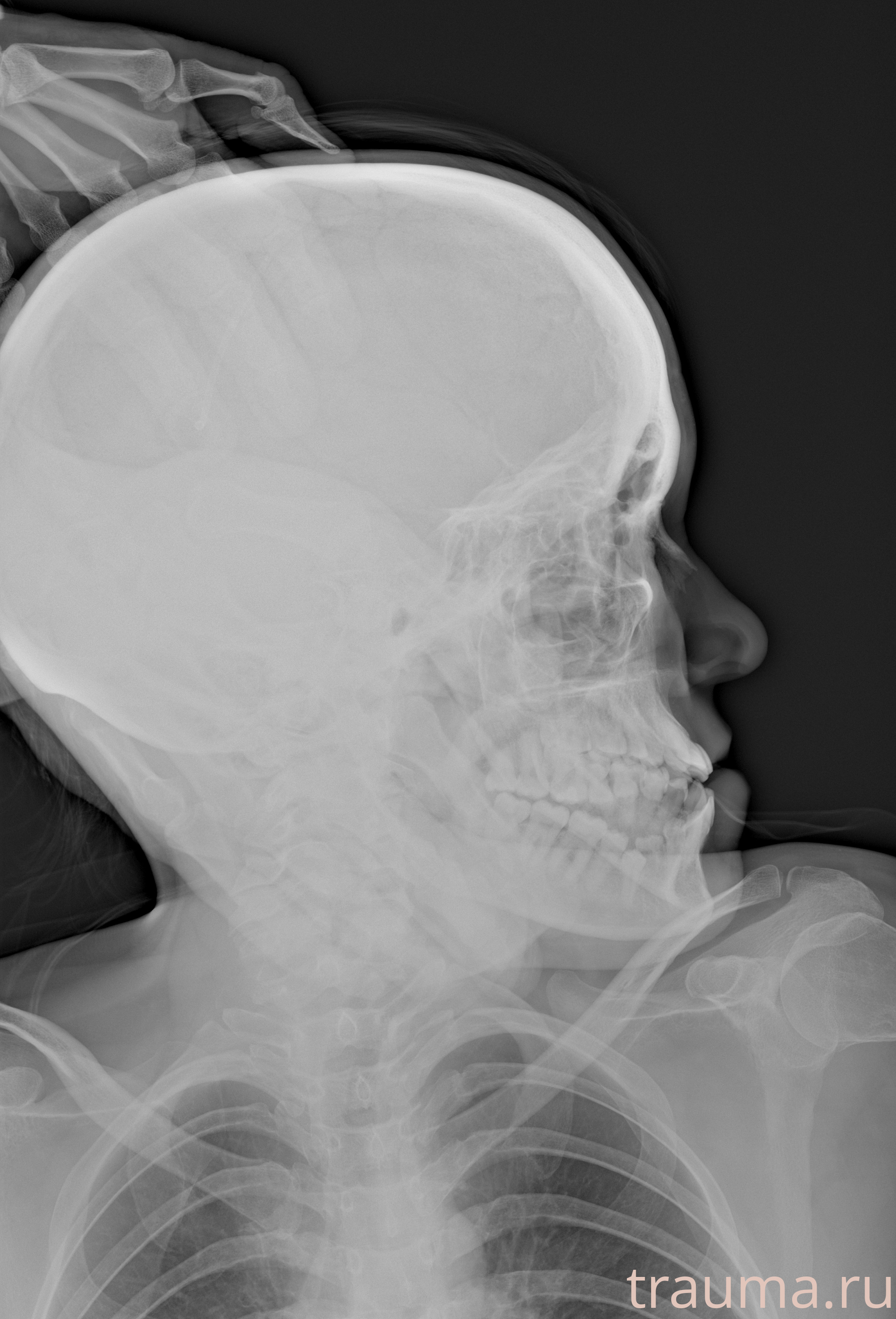 Рентген на дому: по вашему адресу приезжает врач-рентгенолог, травматолог-ортопед с мобильным рентгеновским аппаратом, проводит диагностику травмы или заболевания, делает необходимые рентгенограммы, дает рекомендации по дальнейшему лечению. Получить качественные снимки в домашних условиях возможно благодаря уникальной методике, разработанной МосРентген Центром для института  Склифосовского