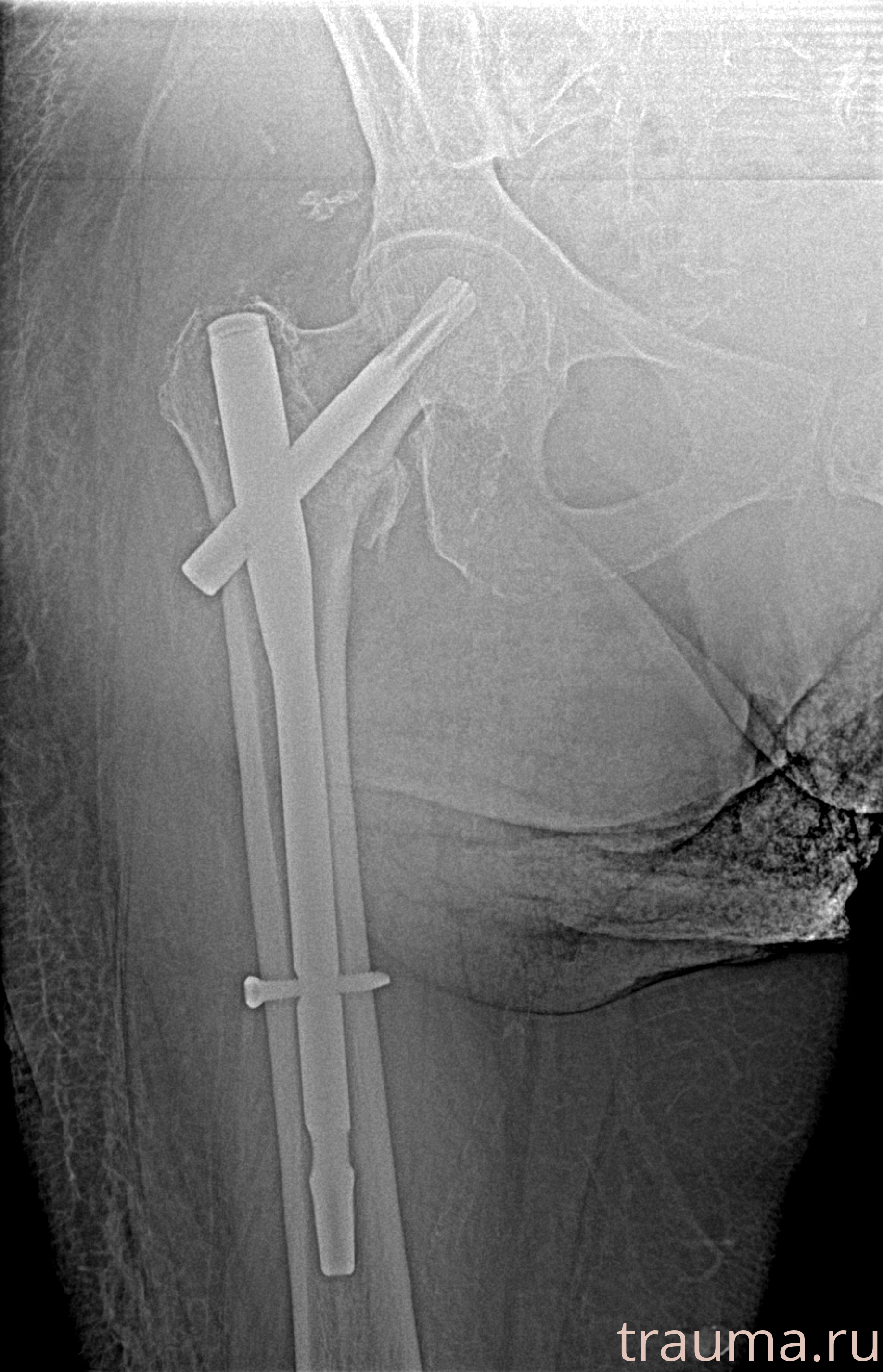 Рентген на дому: по вашему адресу приезжает врач-рентгенолог, травматолог-ортопед с мобильным рентгеновским аппаратом, проводит диагностику травмы или заболевания, делает необходимые рентгенограммы, дает рекомендации по дальнейшему лечению. Получить качественные снимки в домашних условиях возможно благодаря уникальной методике, разработанной МосРентген Центром для института  Склифосовского