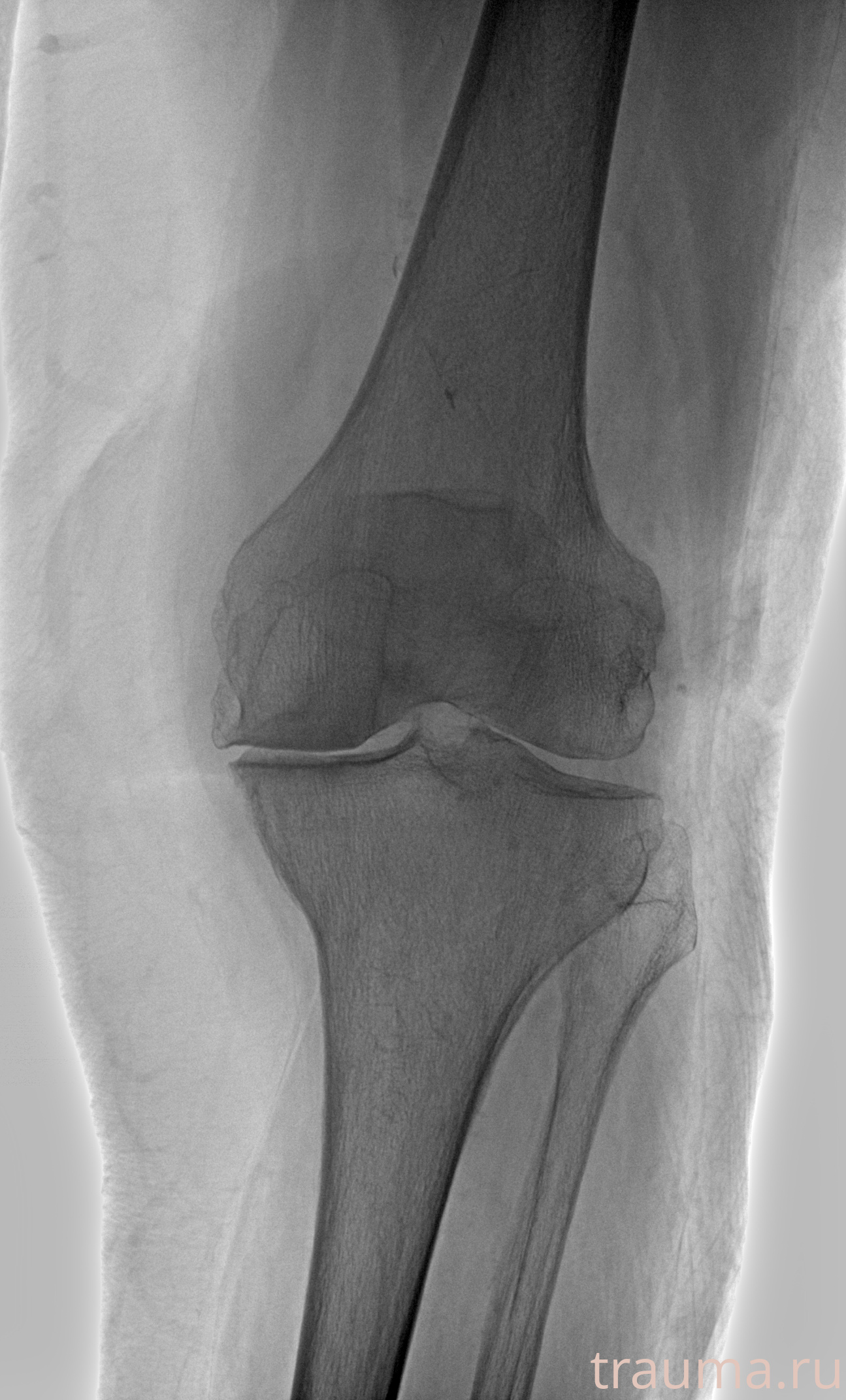 Рентген на дому: по вашему адресу приезжает врач-рентгенолог, травматолог-ортопед с мобильным рентгеновским аппаратом, проводит диагностику травмы или заболевания, делает необходимые рентгенограммы, дает рекомендации по дальнейшему лечению. Получить качественные снимки в домашних условиях возможно благодаря уникальной методике, разработанной МосРентген Центром для института  Склифосовского
