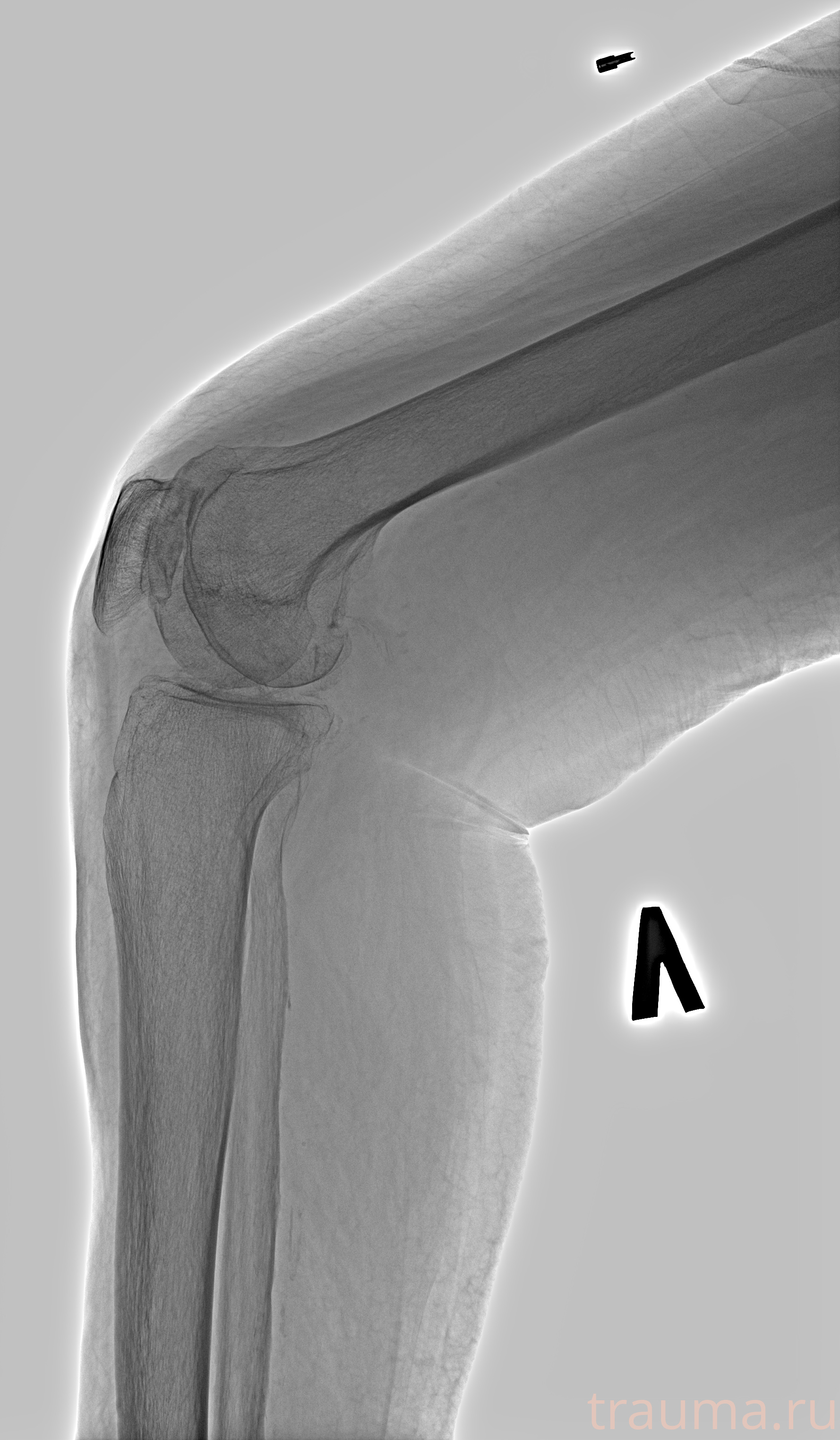 Рентген на дому: по вашему адресу приезжает врач-рентгенолог, травматолог-ортопед с мобильным рентгеновским аппаратом, проводит диагностику травмы или заболевания, делает необходимые рентгенограммы, дает рекомендации по дальнейшему лечению. Получить качественные снимки в домашних условиях возможно благодаря уникальной методике, разработанной МосРентген Центром для института  Склифосовского