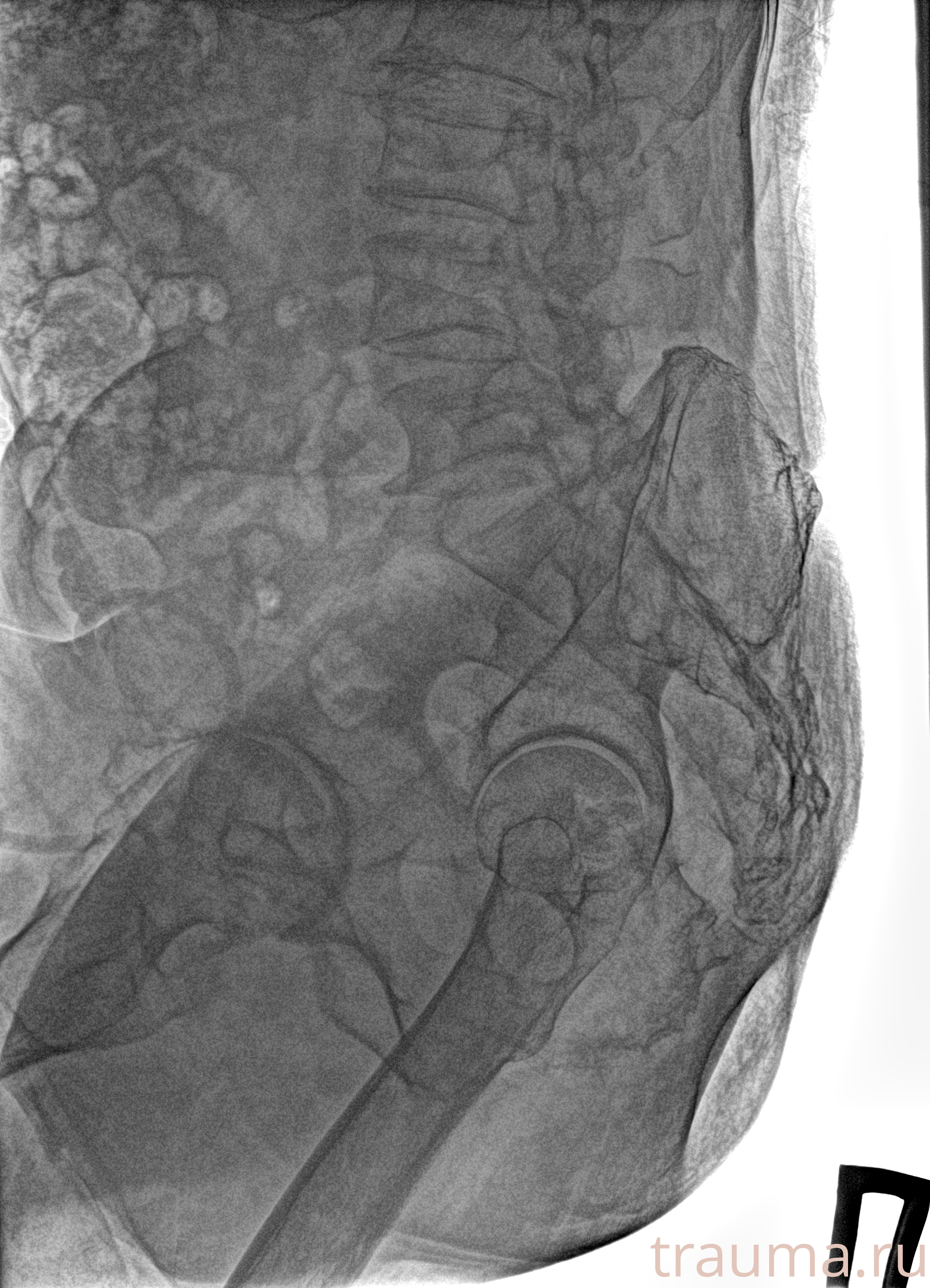 Рентген на дому: по вашему адресу приезжает врач-рентгенолог, травматолог-ортопед с мобильным рентгеновским аппаратом, проводит диагностику травмы или заболевания, делает необходимые рентгенограммы, дает рекомендации по дальнейшему лечению. Получить качественные снимки в домашних условиях возможно благодаря уникальной методике, разработанной МосРентген Центром для института  Склифосовского