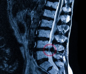 Возможности оценки состояния паравертебральных мышц по данным МРТ перед операцией по поводу стеноза позвоночного канала