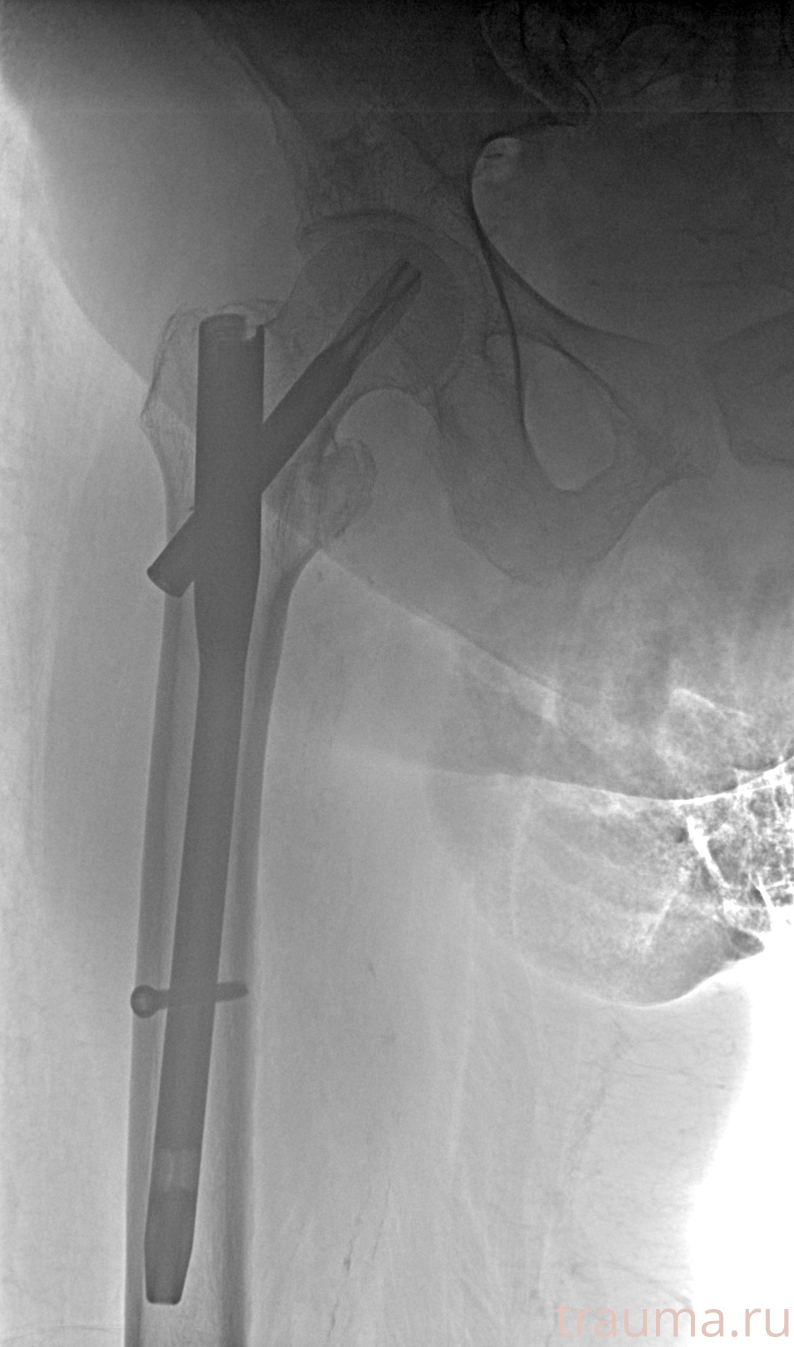 Рентген на дому: по вашему адресу приезжает врач-рентгенолог, травматолог-ортопед с мобильным рентгеновским аппаратом, проводит диагностику травмы или заболевания, делает необходимые рентгенограммы, дает рекомендации по дальнейшему лечению. Получить качественные снимки в домашних условиях возможно благодаря уникальной методике, разработанной МосРентген Центром для института  Склифосовского