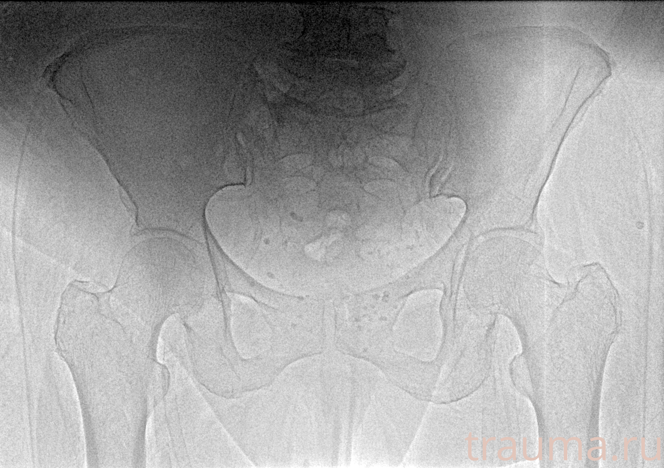 Рентген на дому: по вашему адресу приезжает врач-рентгенолог, травматолог-ортопед с мобильным рентгеновским аппаратом, проводит диагностику травмы или заболевания, делает необходимые рентгенограммы, дает рекомендации по дальнейшему лечению. Получить качественные снимки в домашних условиях возможно благодаря уникальной методике, разработанной МосРентген Центром для института  Склифосовского