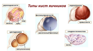 Неэпителиальные опухоли яичников