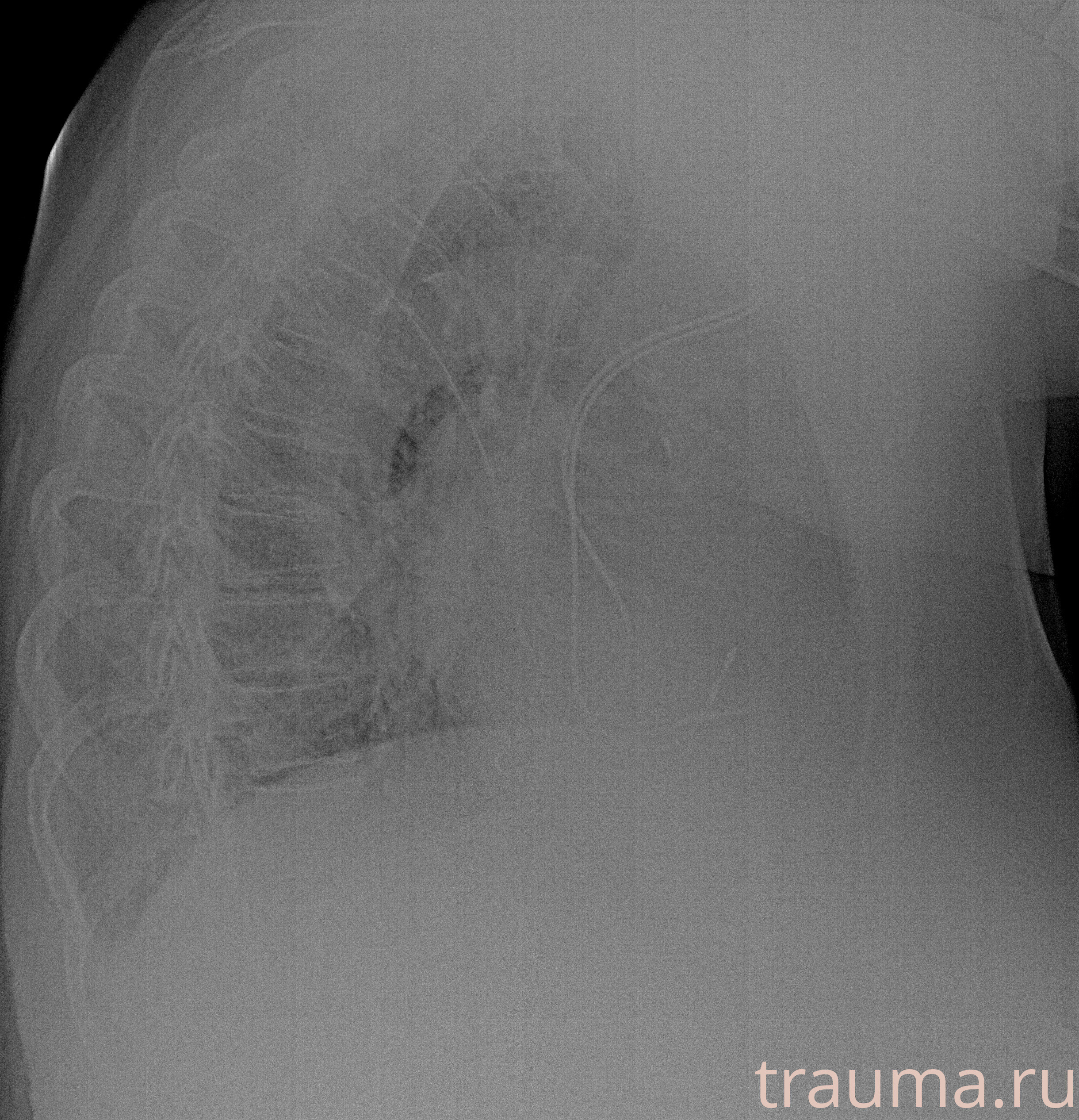 Рентген на дому: по вашему адресу приезжает врач-рентгенолог, травматолог-ортопед с мобильным рентгеновским аппаратом, проводит диагностику травмы или заболевания, делает необходимые рентгенограммы, дает рекомендации по дальнейшему лечению. Получить качественные снимки в домашних условиях возможно благодаря уникальной методике, разработанной МосРентген Центром для института  Склифосовского