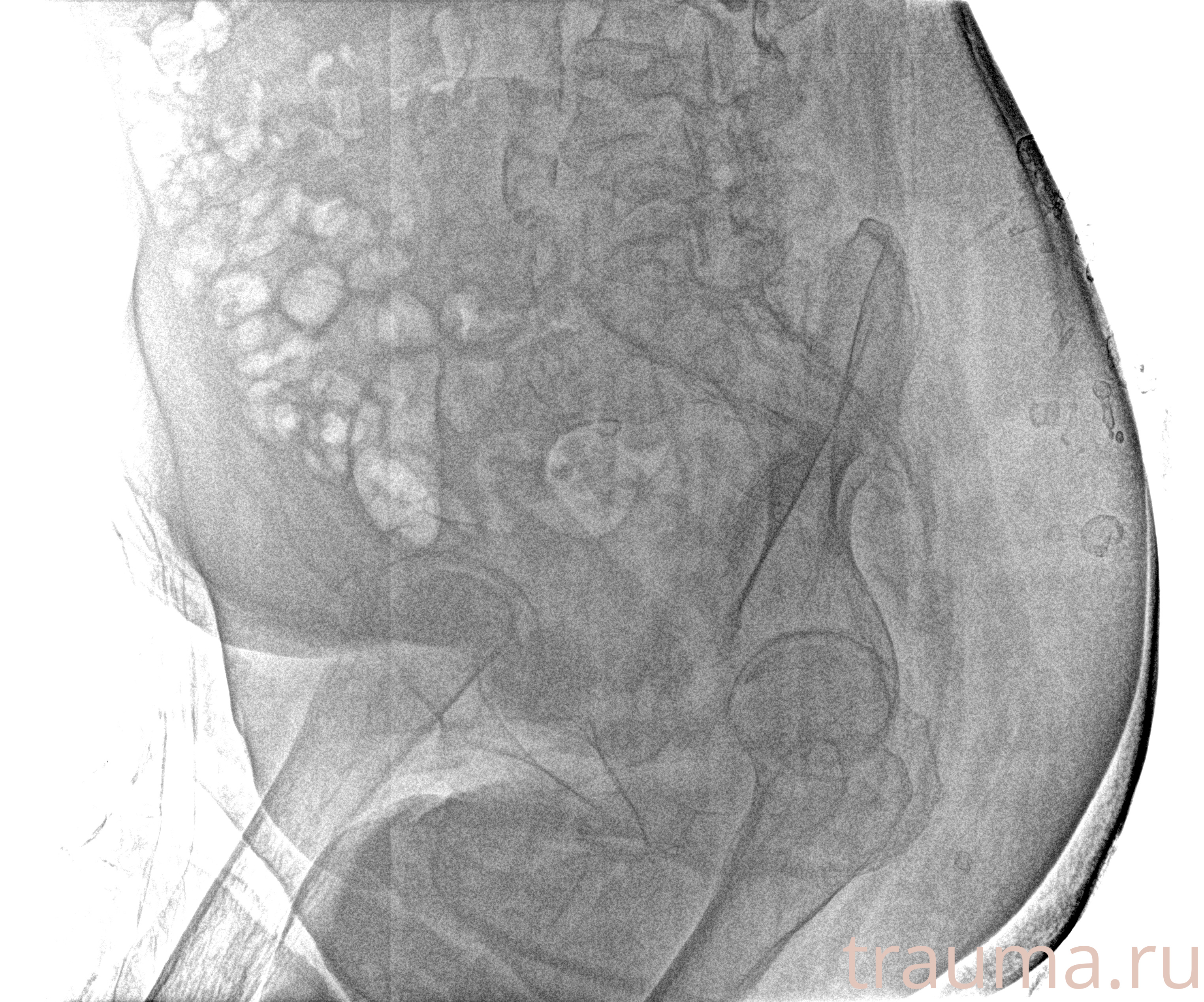 Рентген на дому: по вашему адресу приезжает врач-рентгенолог, травматолог-ортопед с мобильным рентгеновским аппаратом, проводит диагностику травмы или заболевания, делает необходимые рентгенограммы, дает рекомендации по дальнейшему лечению. Получить качественные снимки в домашних условиях возможно благодаря уникальной методике, разработанной МосРентген Центром для института  Склифосовского